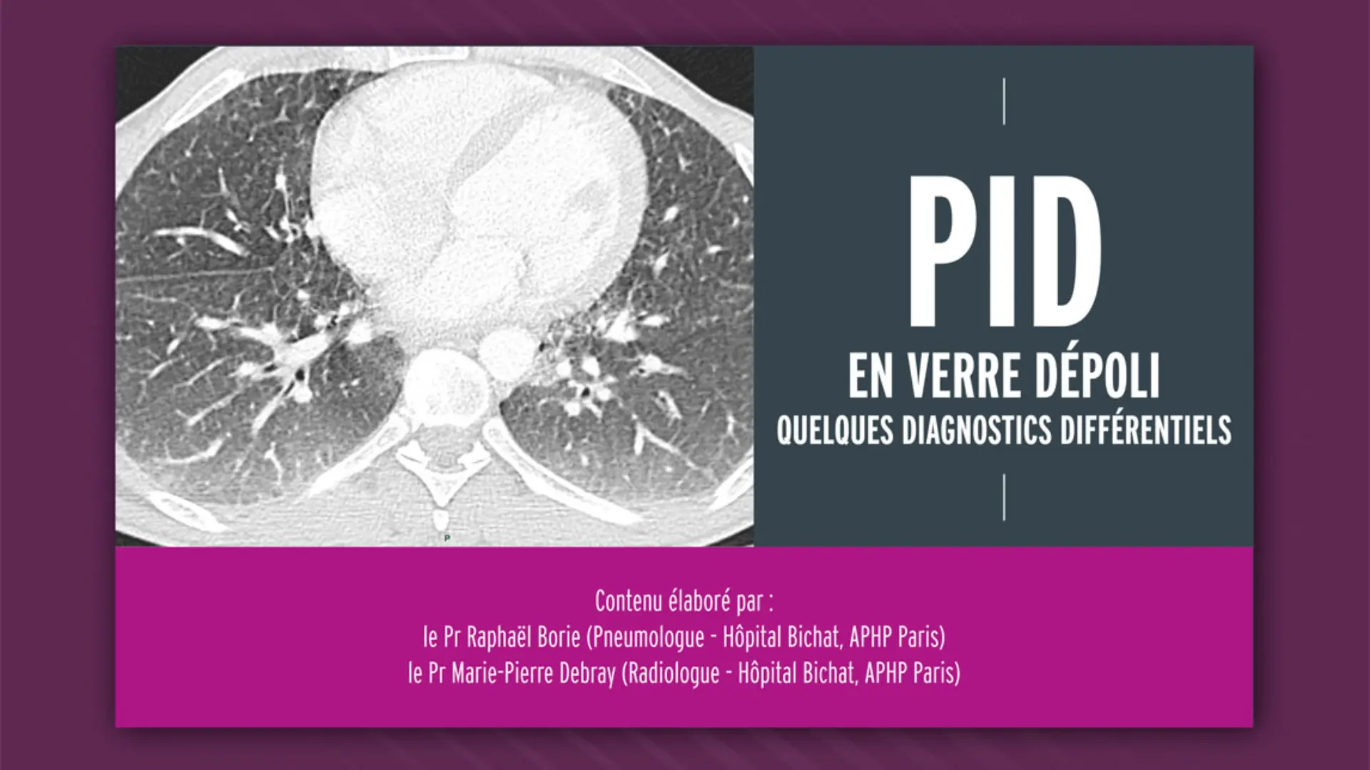 ASMD (Acid Sphingomyelinase Deficiency) - Informations pour les ...
