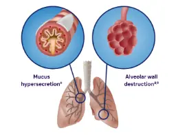 Role of type 2 inflammation in COPD | Campus Sanofi