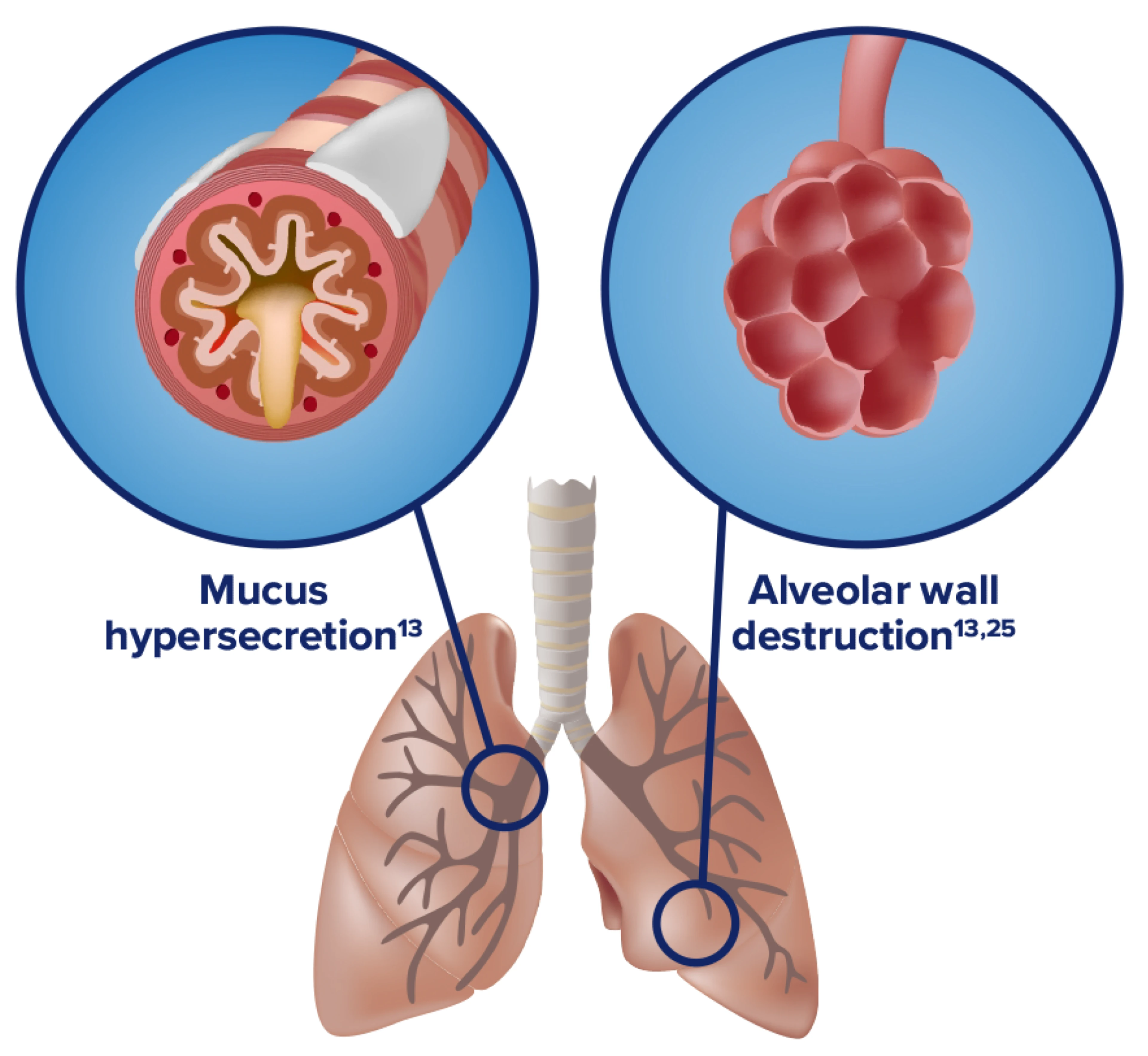 Mucus hypersecretion and Alveolar wall destruction