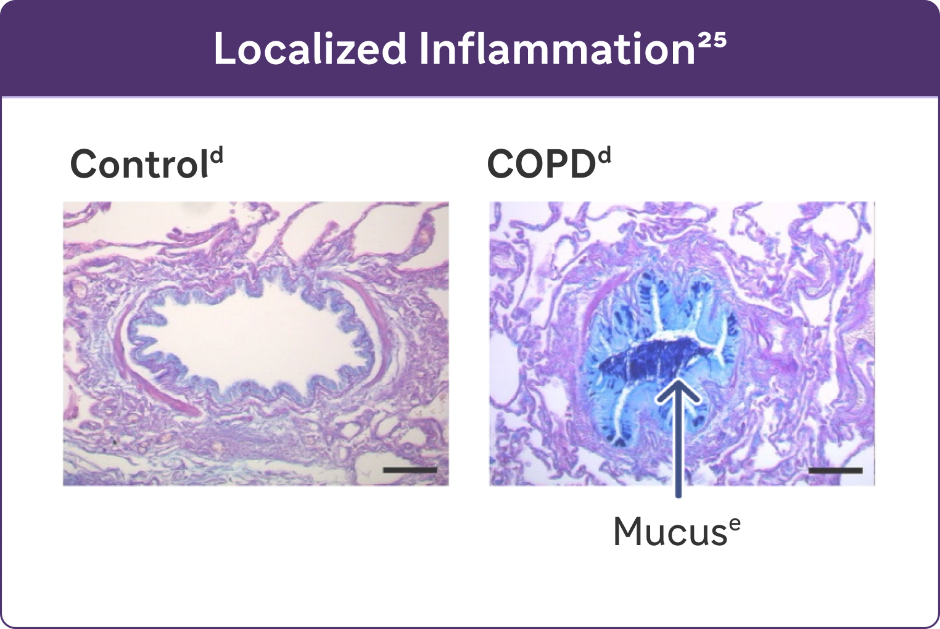 Localized Inflammation : Illustration representing  mucus in control next to illustration representing mucus in COPD