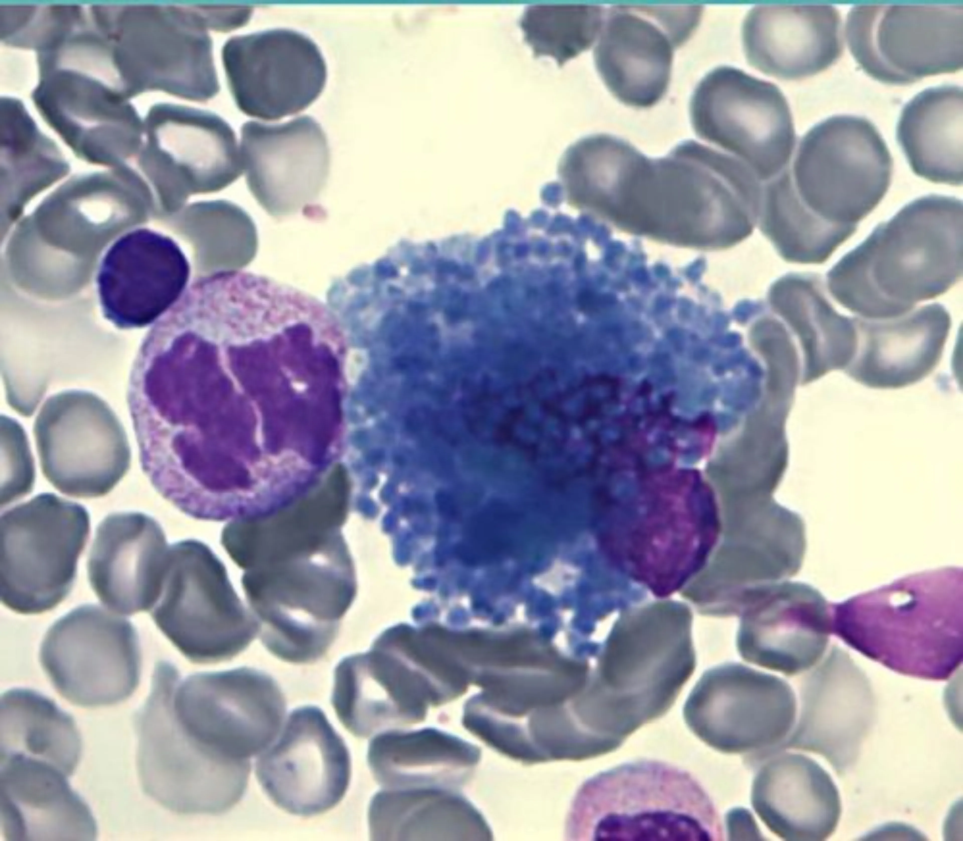 Histiocyte bleu de mer : Myélogramme d'un patient ASMD type B