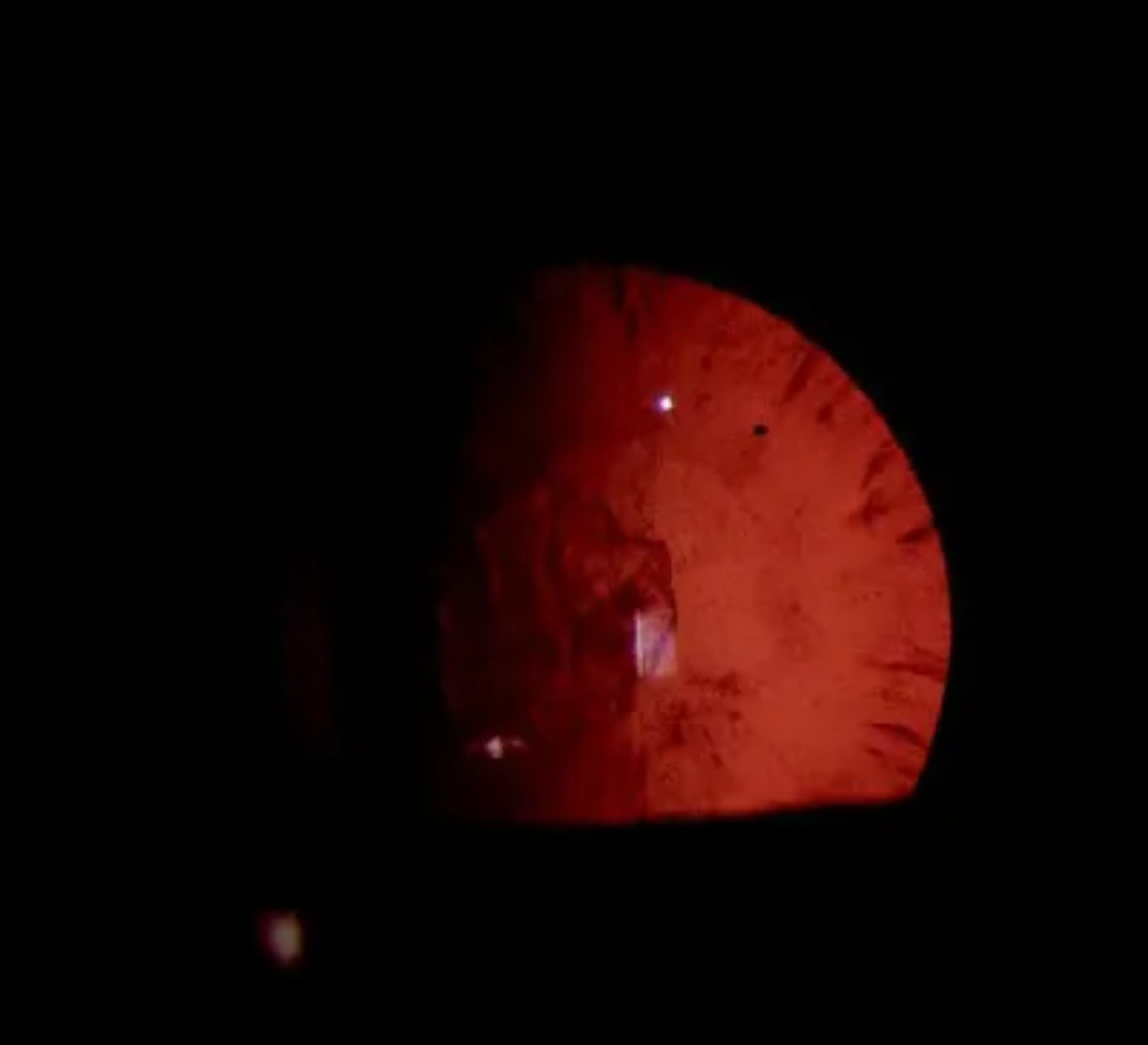 Un gros plan d’un œil avec une cataracte antérieure