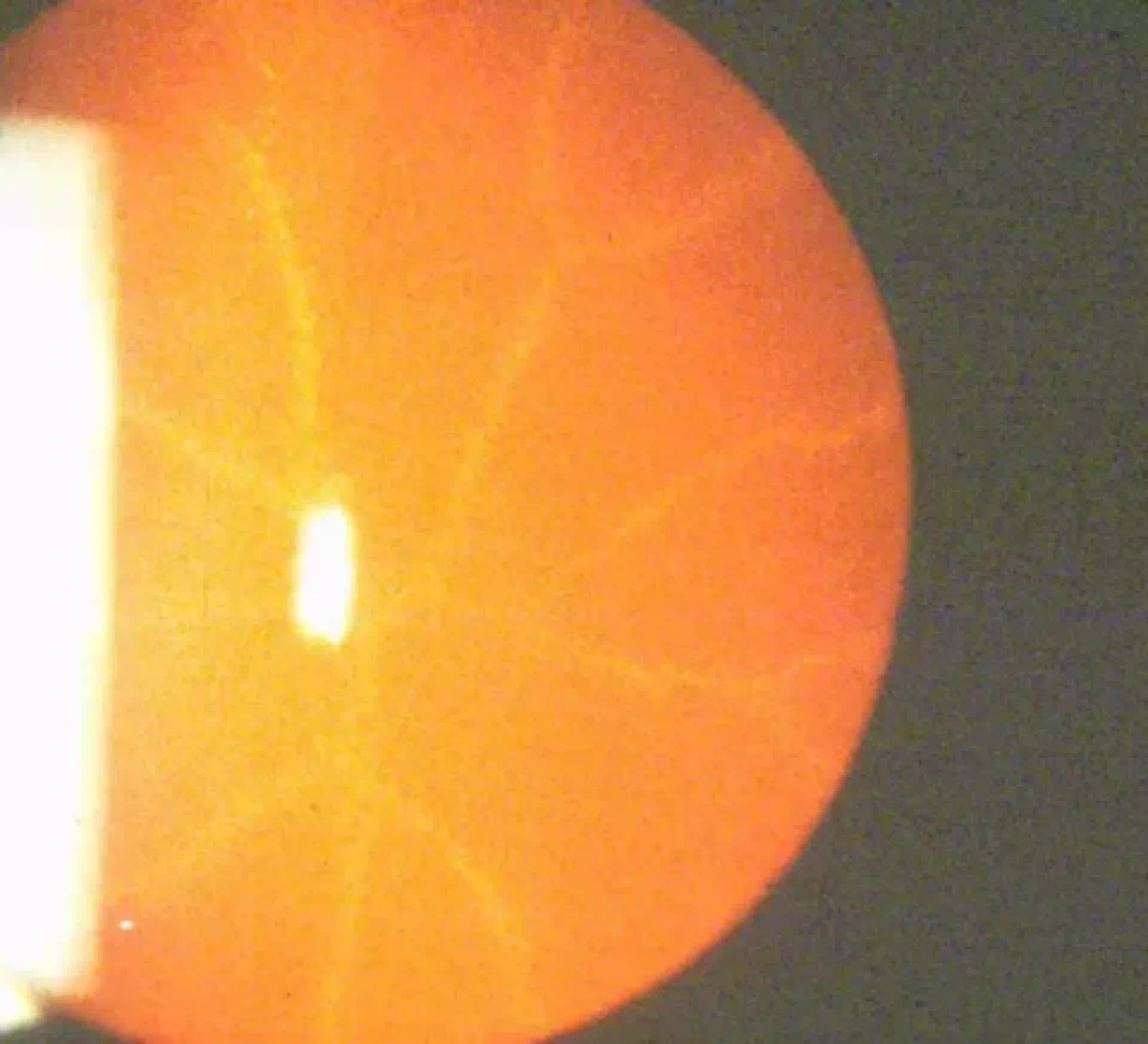 Un gros plan d’un œil avec une cataracte postérieure