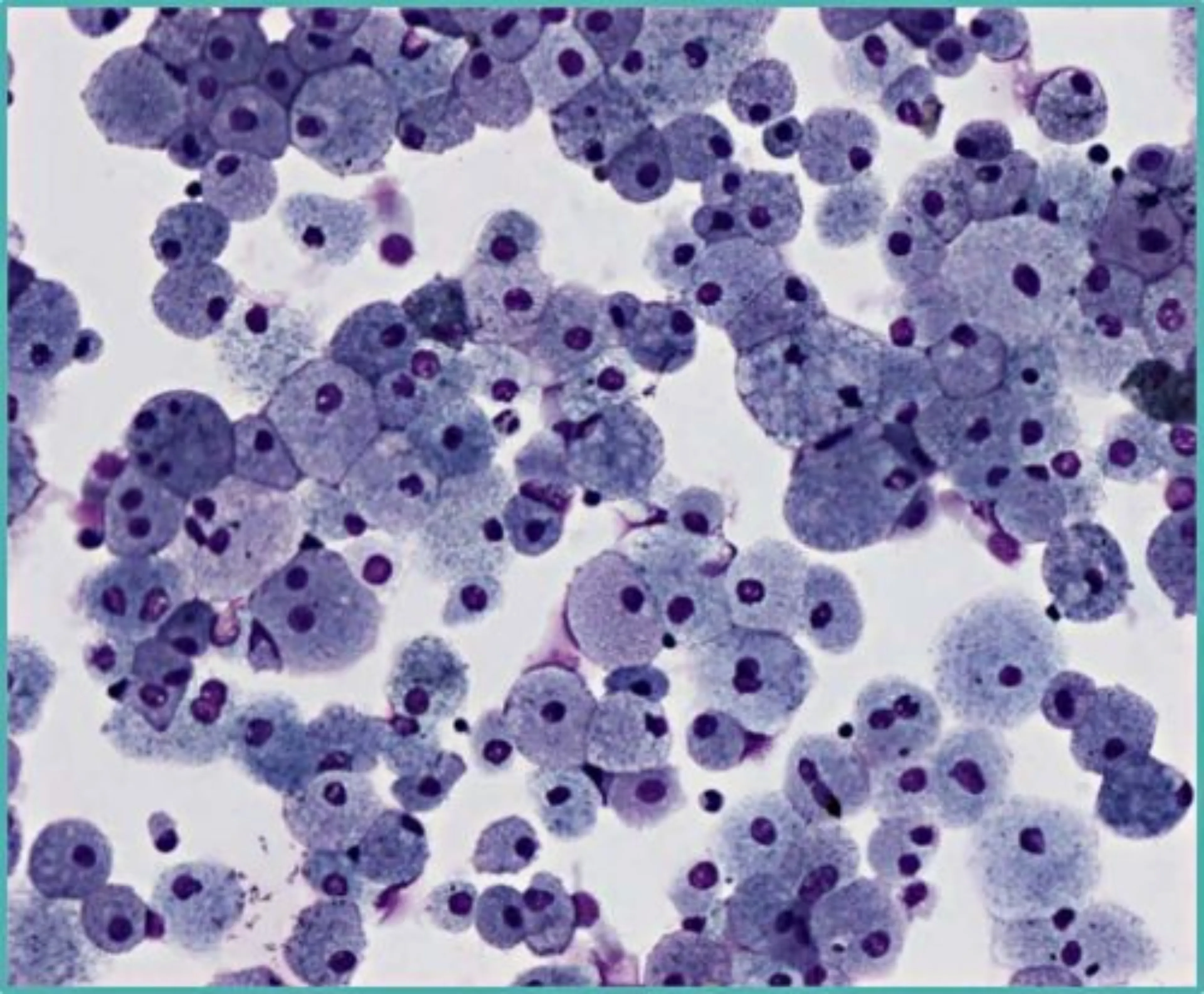 Macrophages spumeux : LBA d'une patiente ASMD de type B
