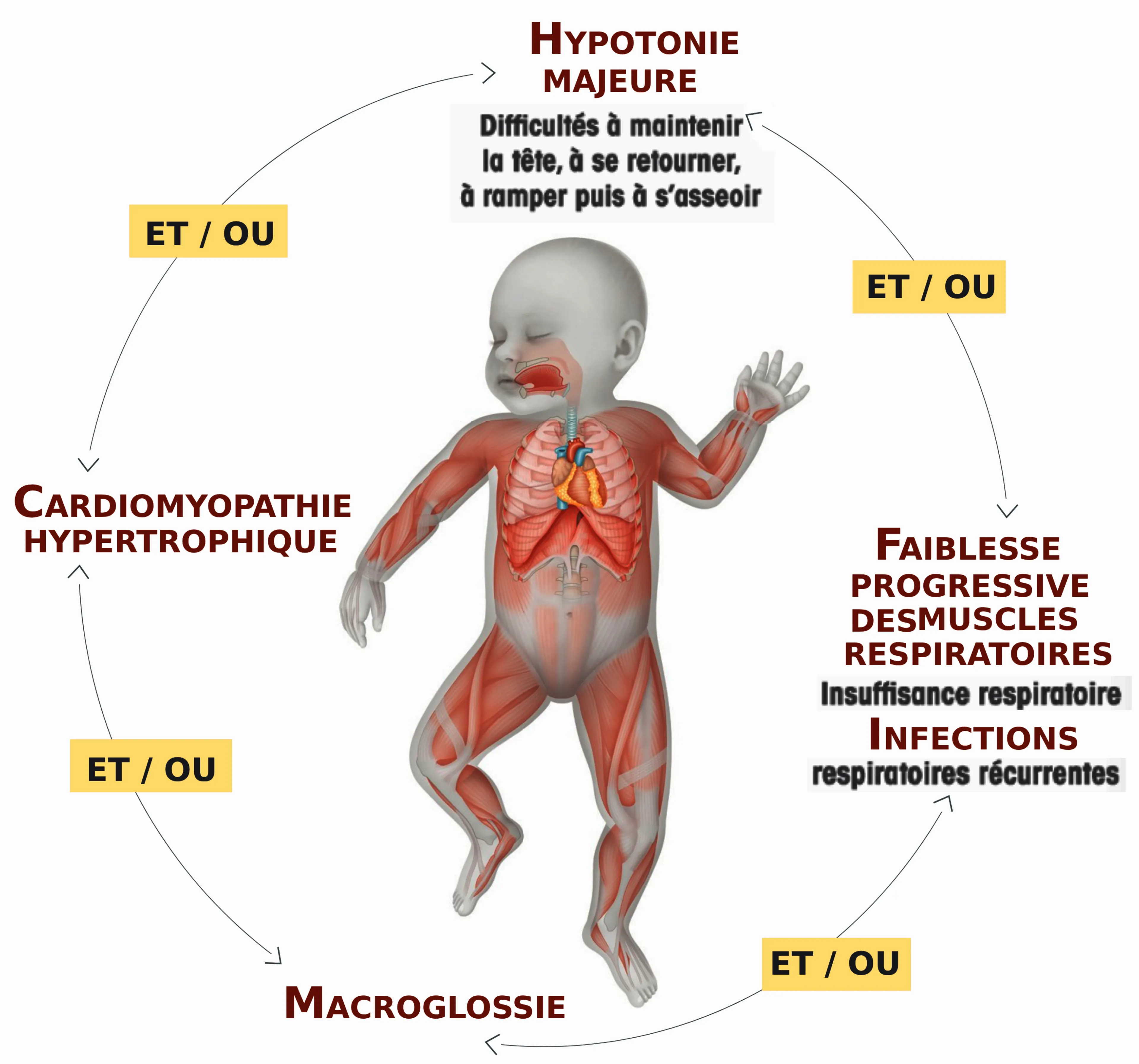 humanoïde enfant de face et de dos avec le détail des principaux signes d’appel : faiblesse musculaire, déformation du rachis