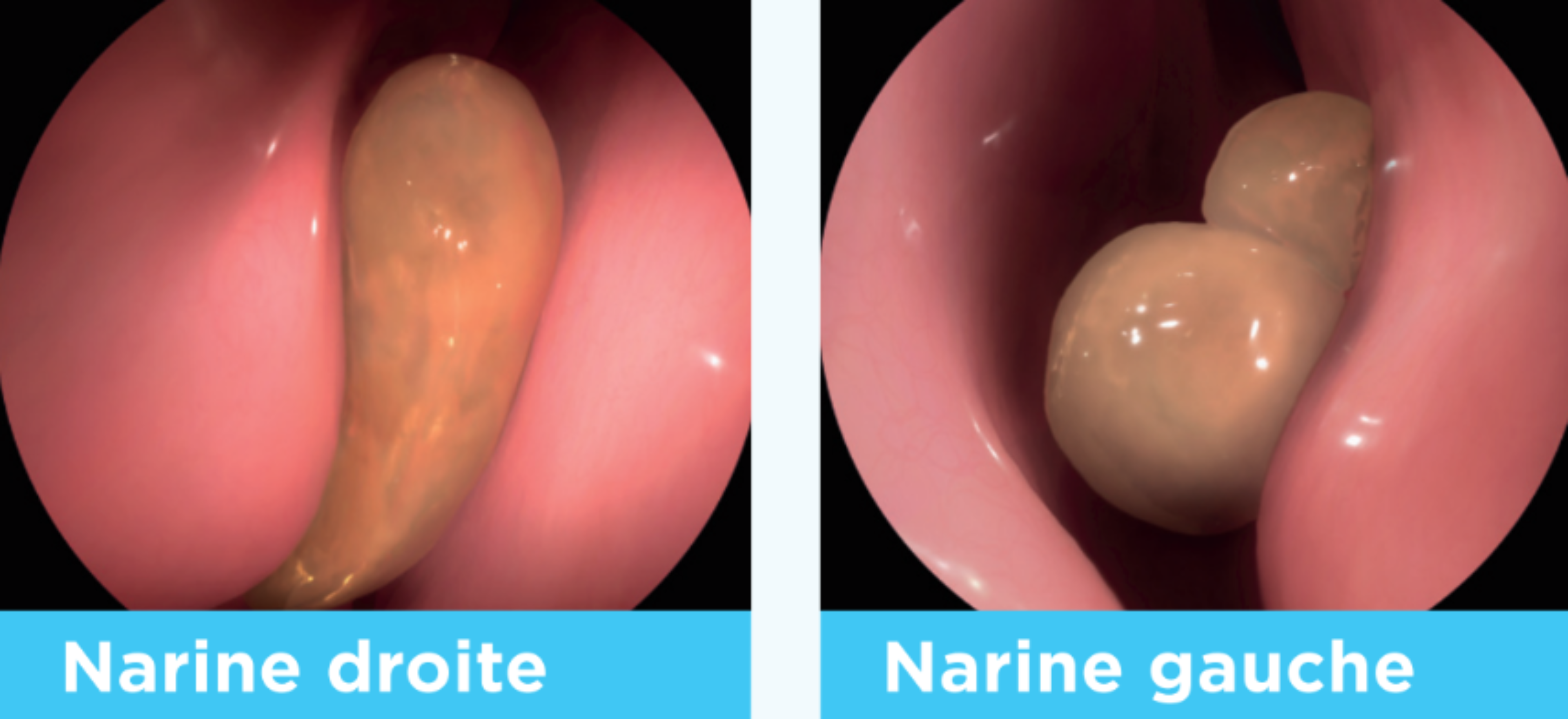 Endoscopie pour narine gauche et narine droite