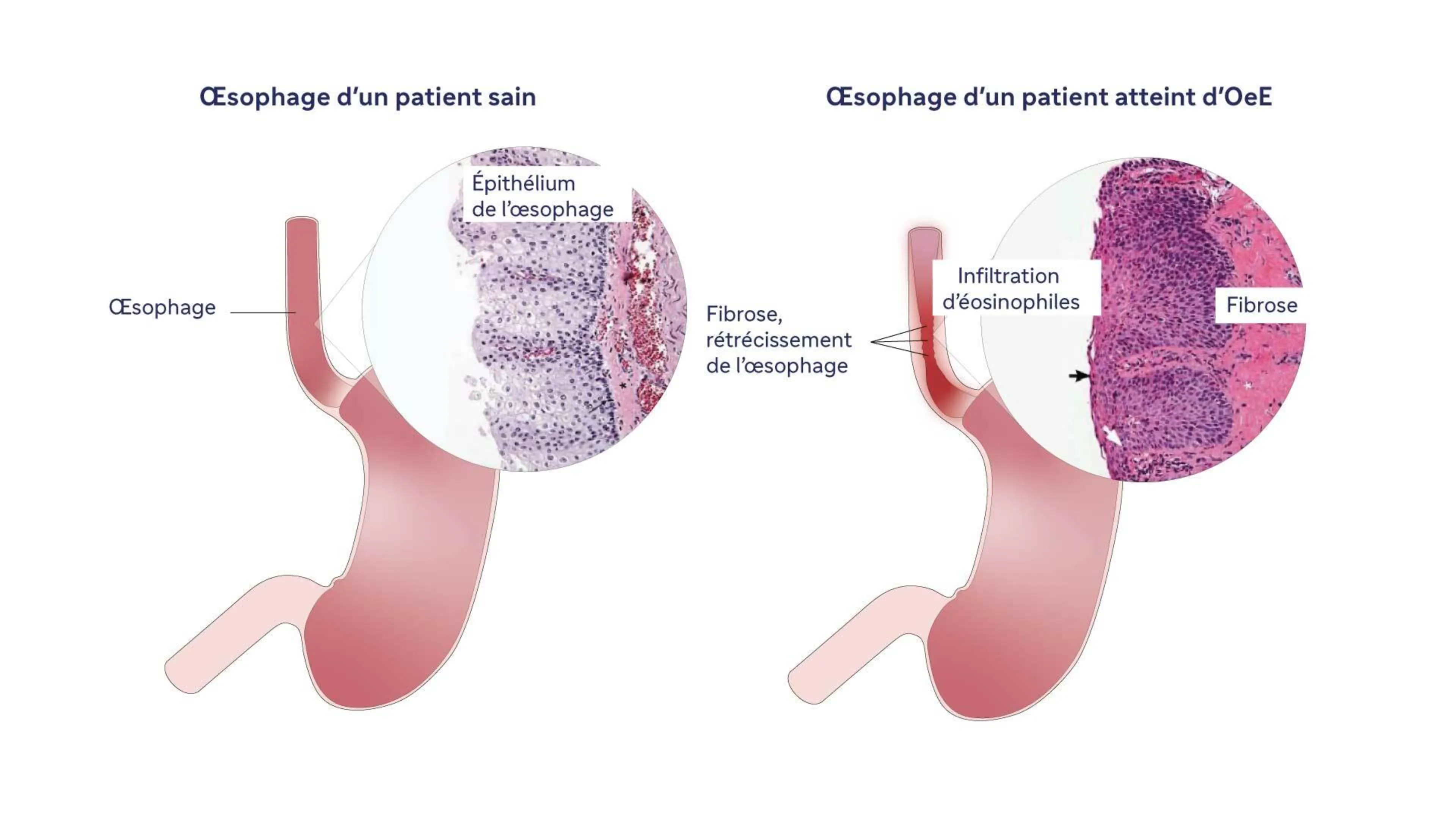 image "œsophage d'un patient sain vs un patient atteint d'OeE"