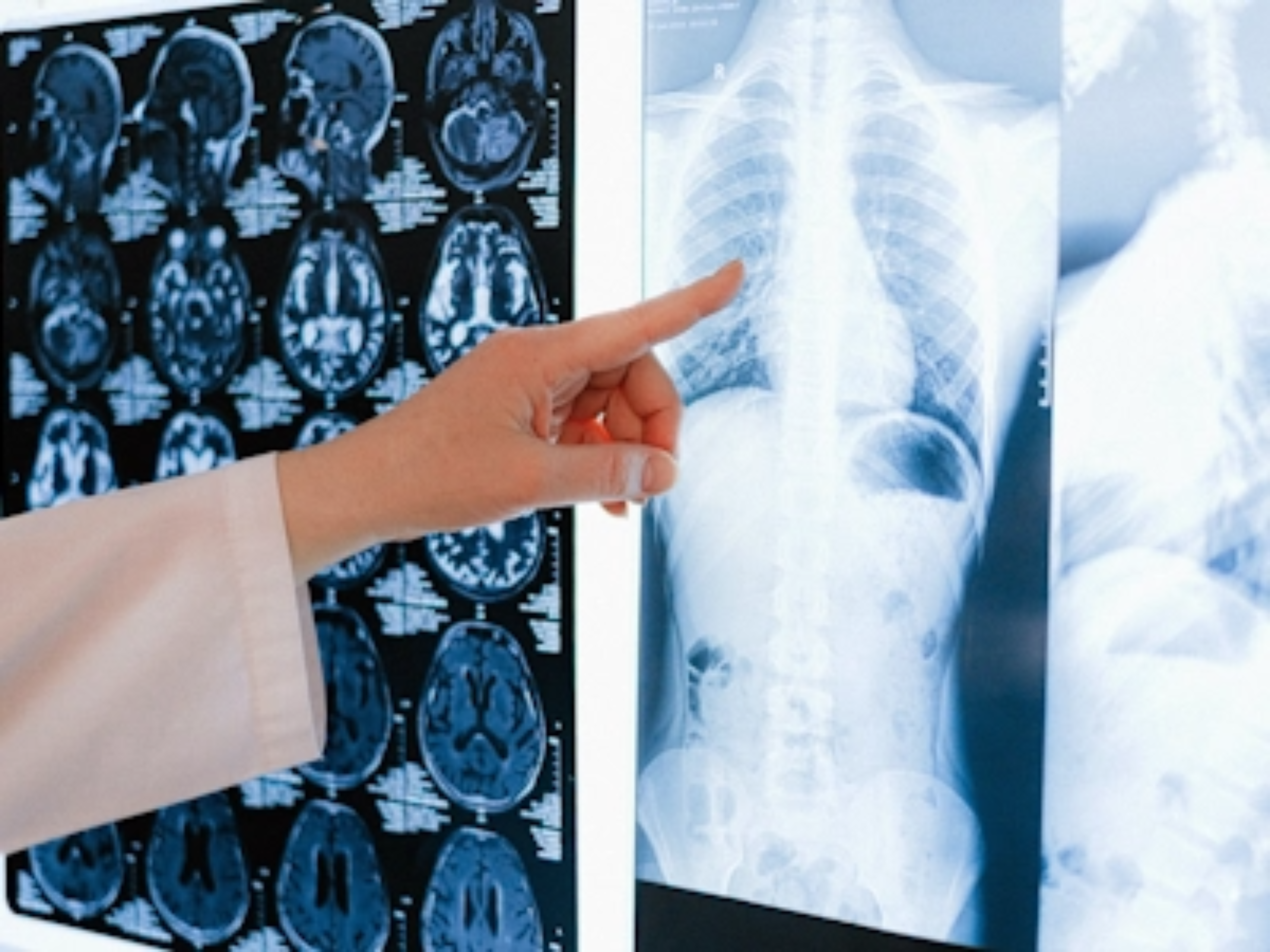 Ein Röntgenbild zur Untersuchung auf pneumologische Symptome von ASMD wird analysiert
