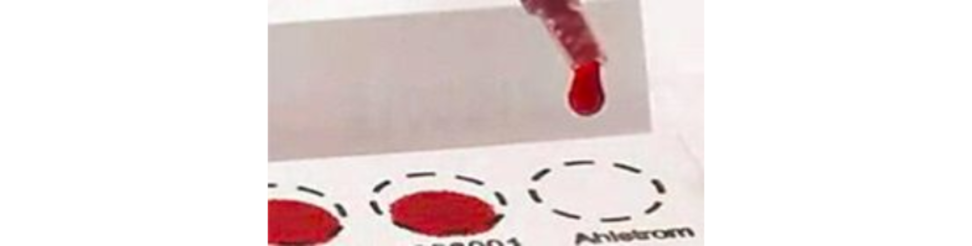 Morbus Fabry Diagnostik – Bestimmung der Enzymaktivität