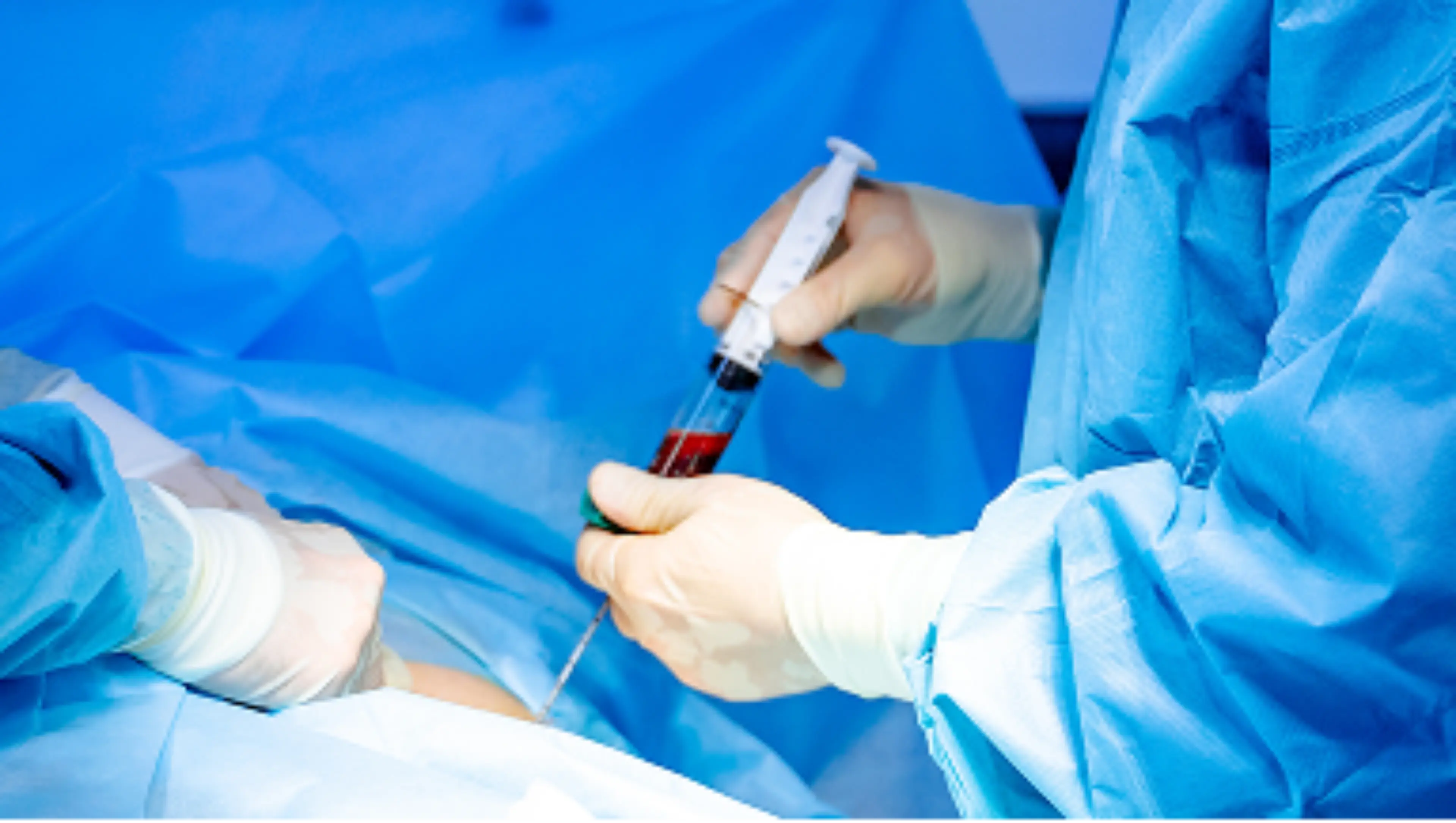 Entnahme einer Knochenmarkprobe beim Multiplen Myelom im Rahmen von Hochrisiko-Zytogenetik