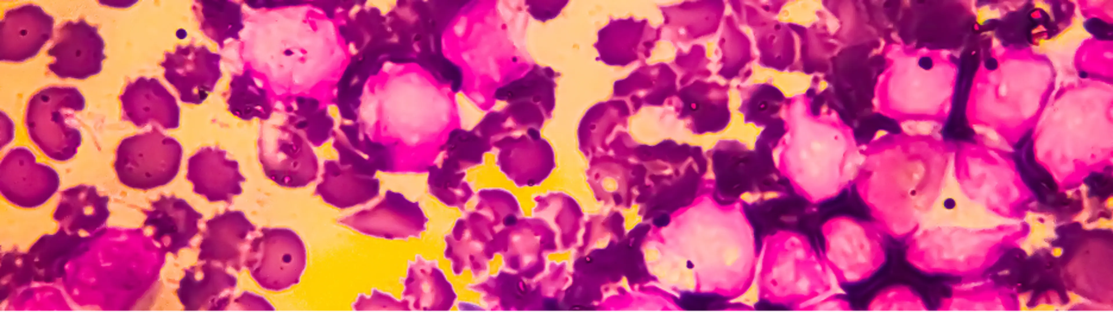 Wenn das Multiple Myelom progredient wird, spricht man von einem rezidivierten und refraktären Multiplen Myelom (RRMM)