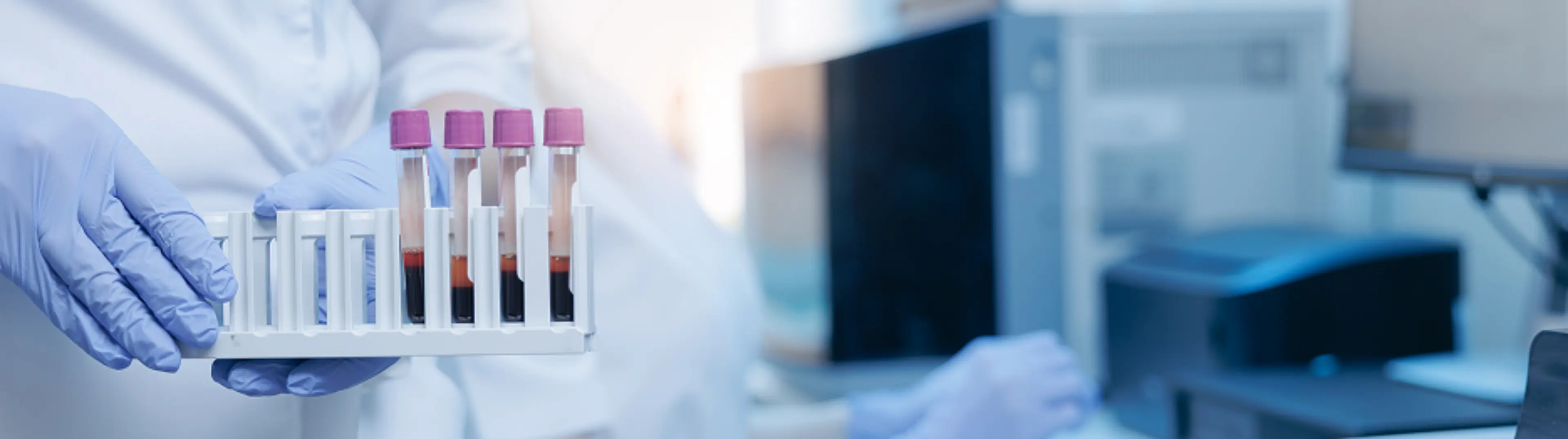 Untersuchung einer Blutprobe im Labor zur Bestimmung von Myelom-Parametern