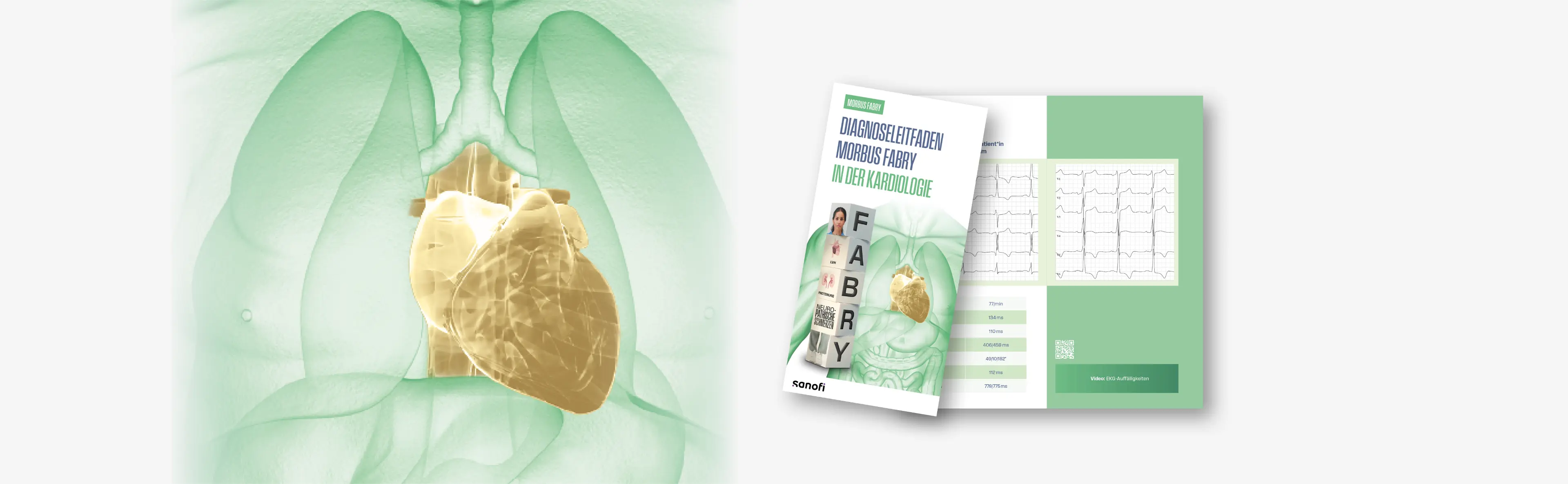 Anatomische Illustration des menschlichen Herzens bei Morbus Fabry – Diagnoseleitfaden Kardiologie.