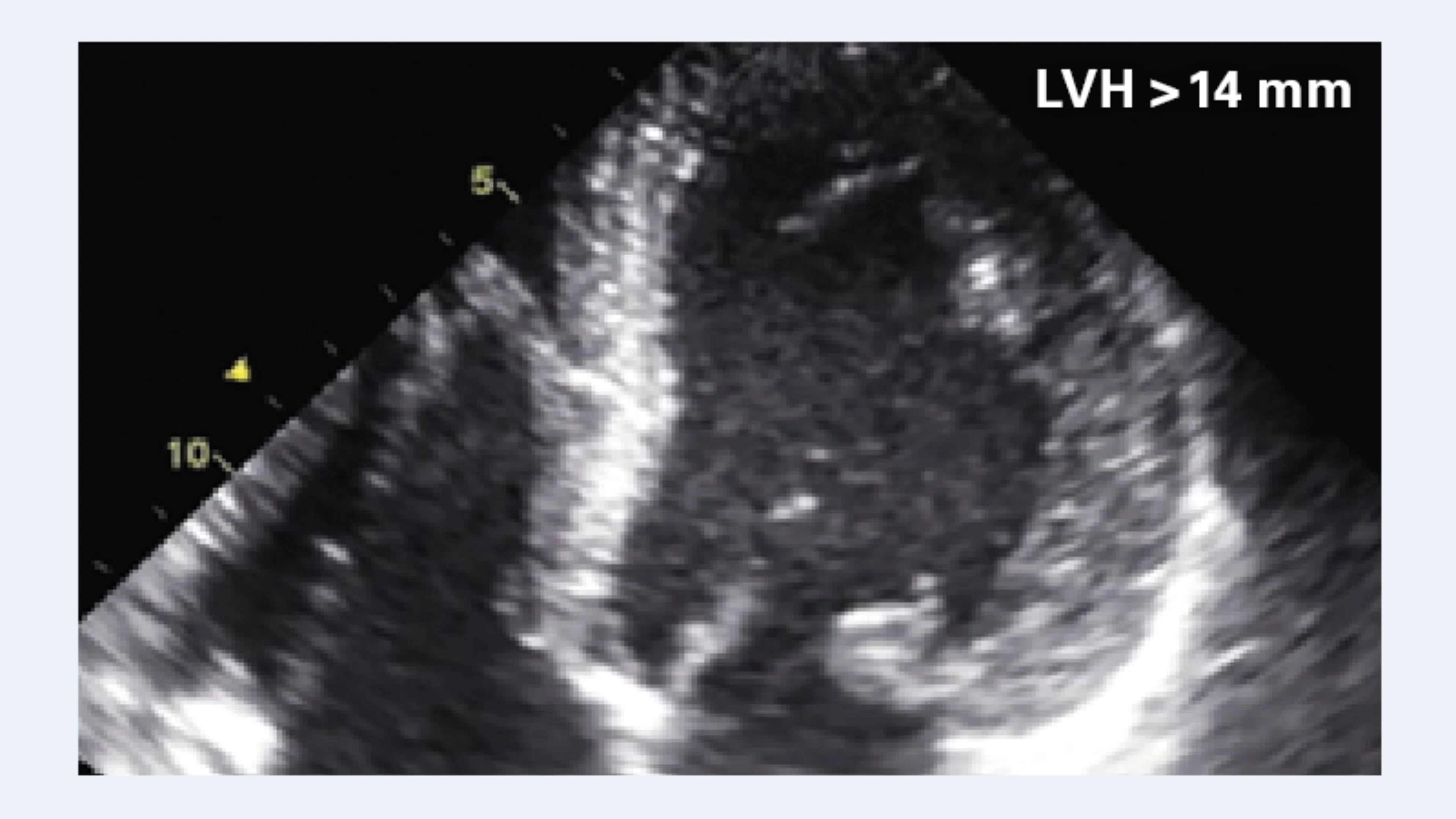 Schwarz-weißer Ultraschall des Herzens mit Text 'LVH > 14 mm' oben rechts.