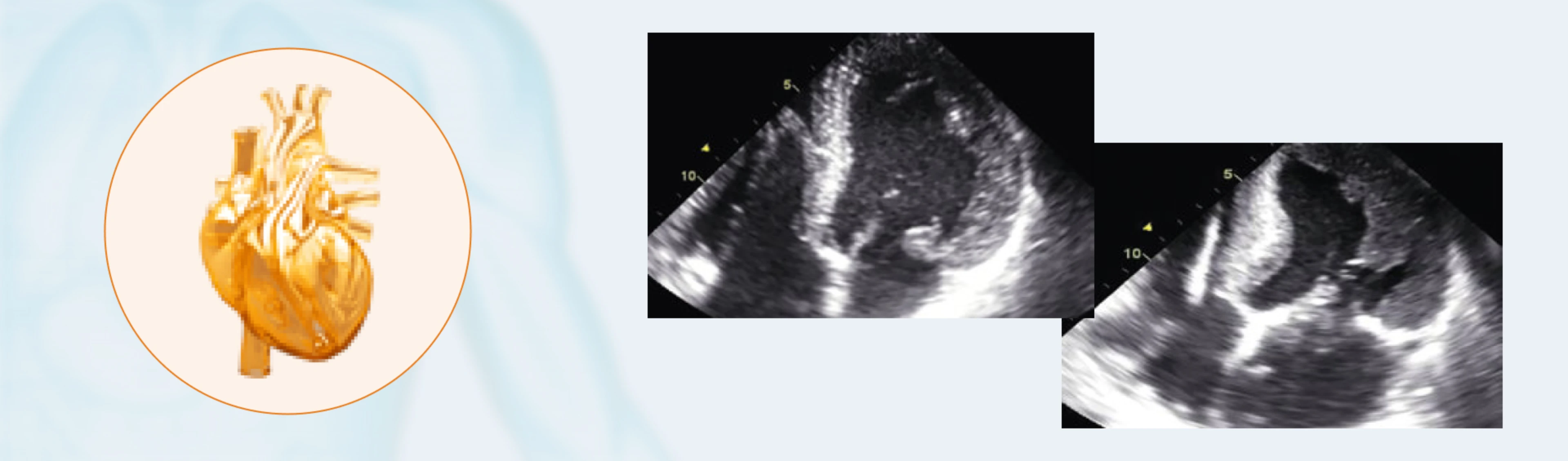 Drei Darstellungen eines Herzens: links eine schematische, orangefarbene Illustration, rechts zwei schwarz-weiße Ultraschallbilder.