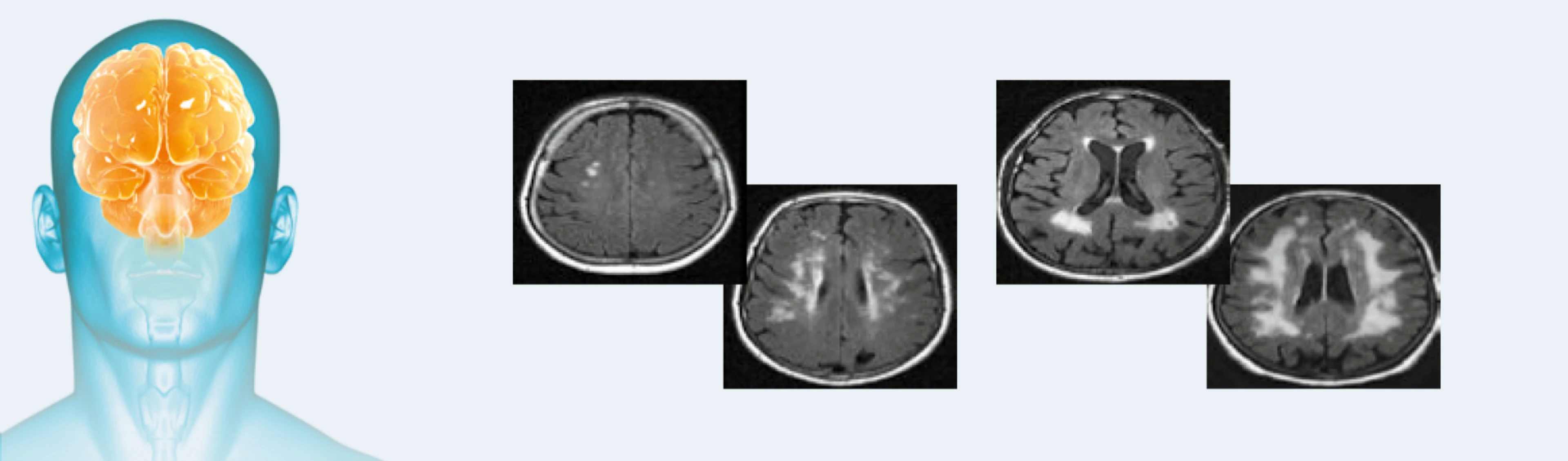 Blau-transparentes Kopfmodell mit orangefarbenem Gehirn, daneben vier schwarz-weiße MRT-Scans des Gehirns in verschiedenen Querschnitten.