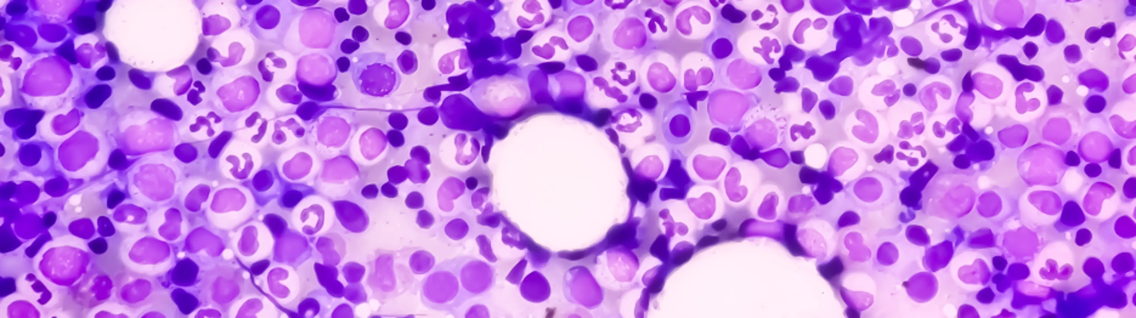 Das Multiple Myelom unter dem Mikroskop