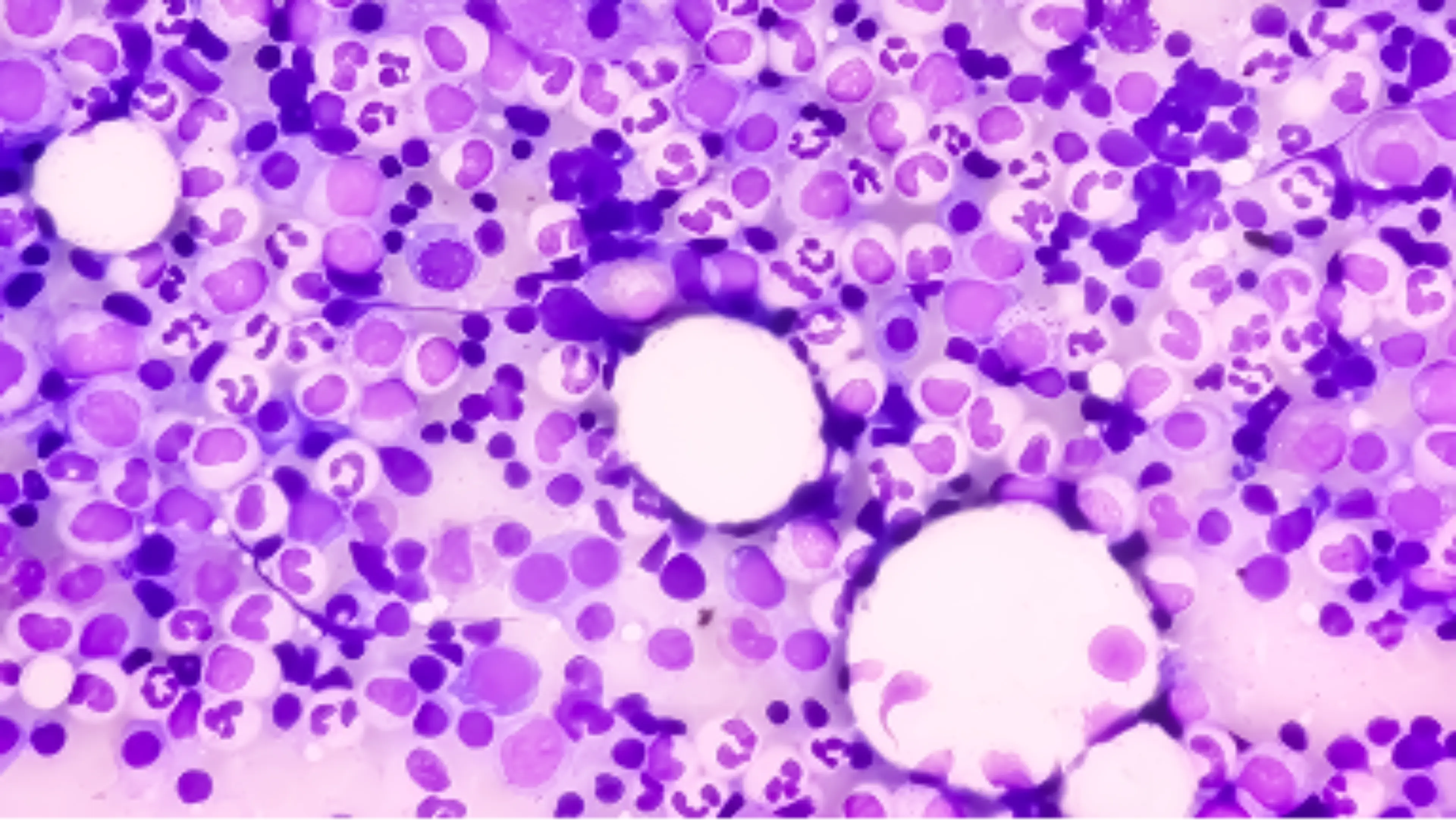 Das Multiple Myelom unter dem Mikroskop