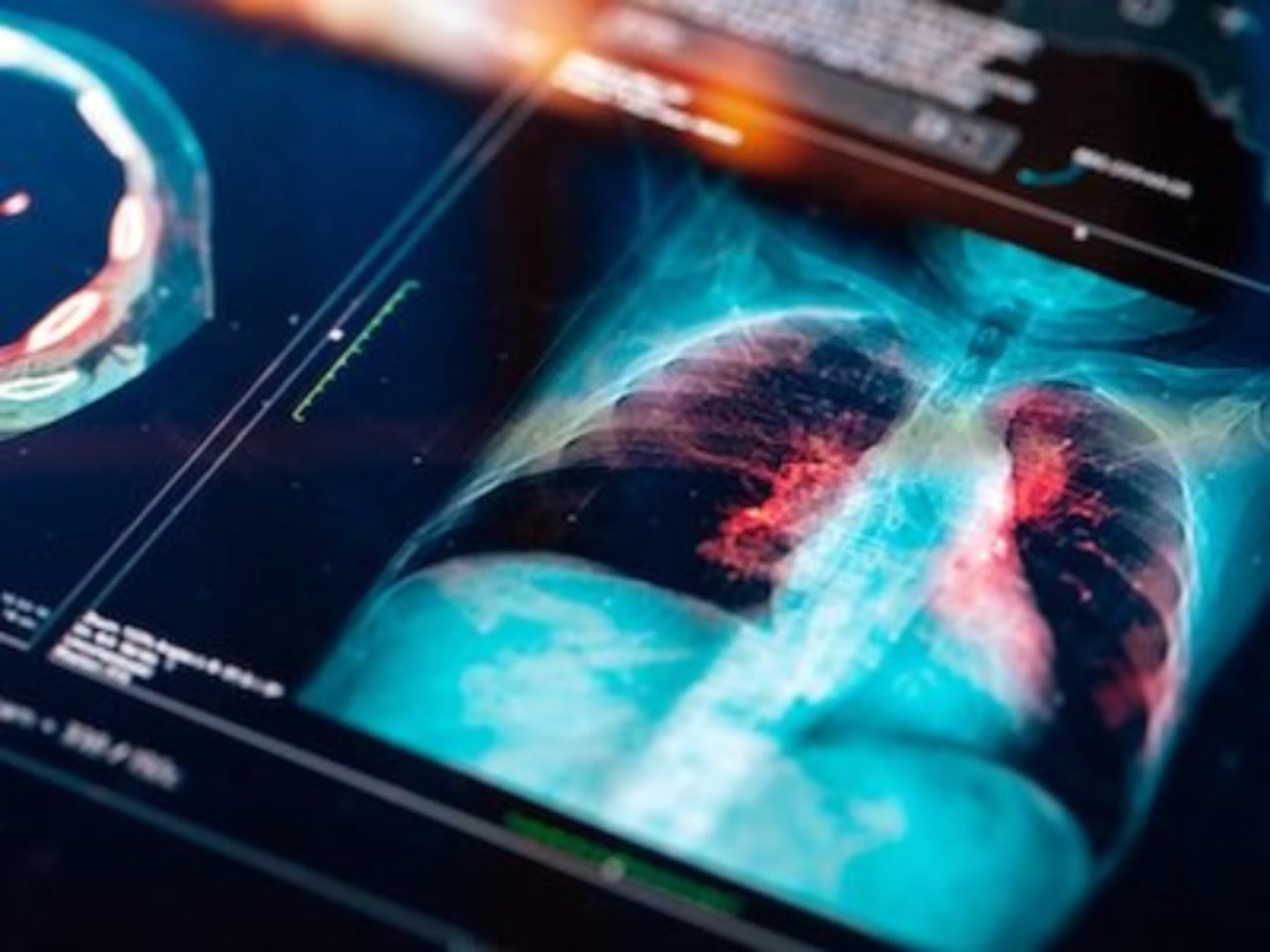  Safety profile of preoperative administration of low-molecular-weight heparin for Lung Cancer population