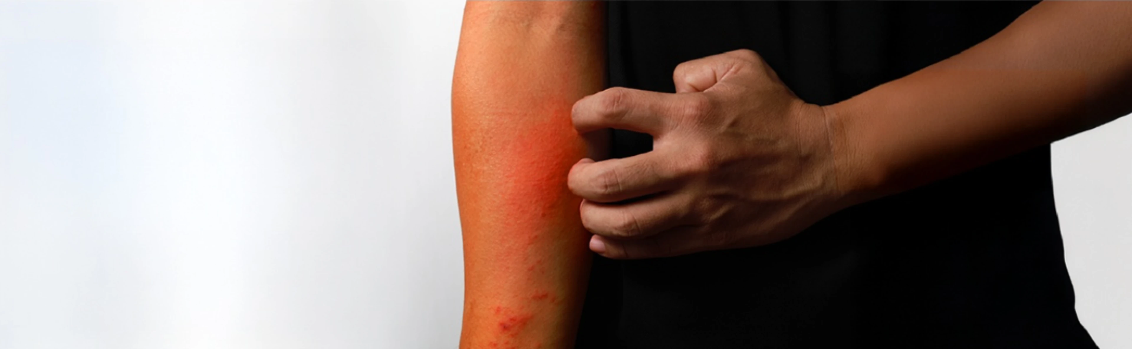 calidad-vida-dermatitis-atopica-no-controlada-hb
