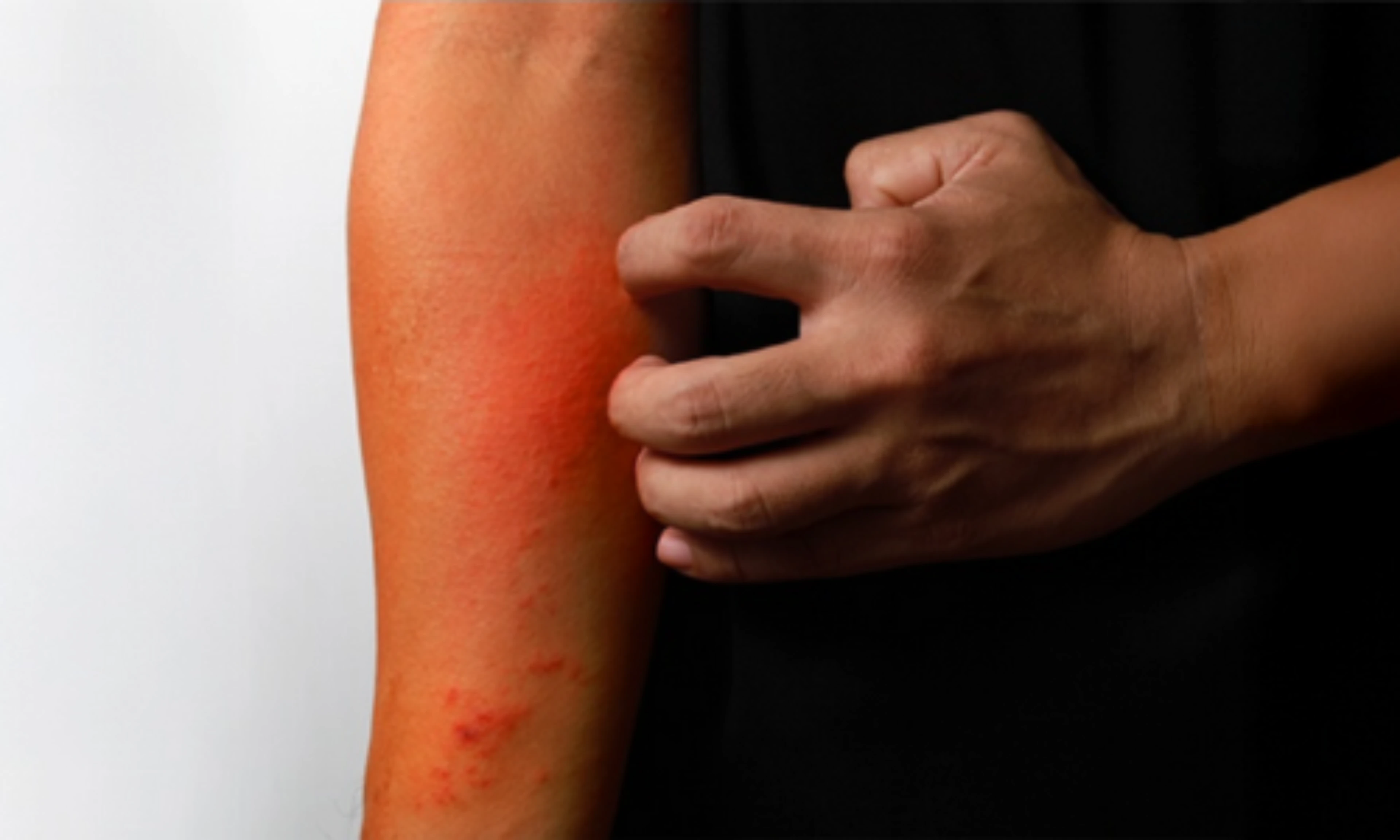calidad-vida-dermatitis-atopica-no-controlada-th