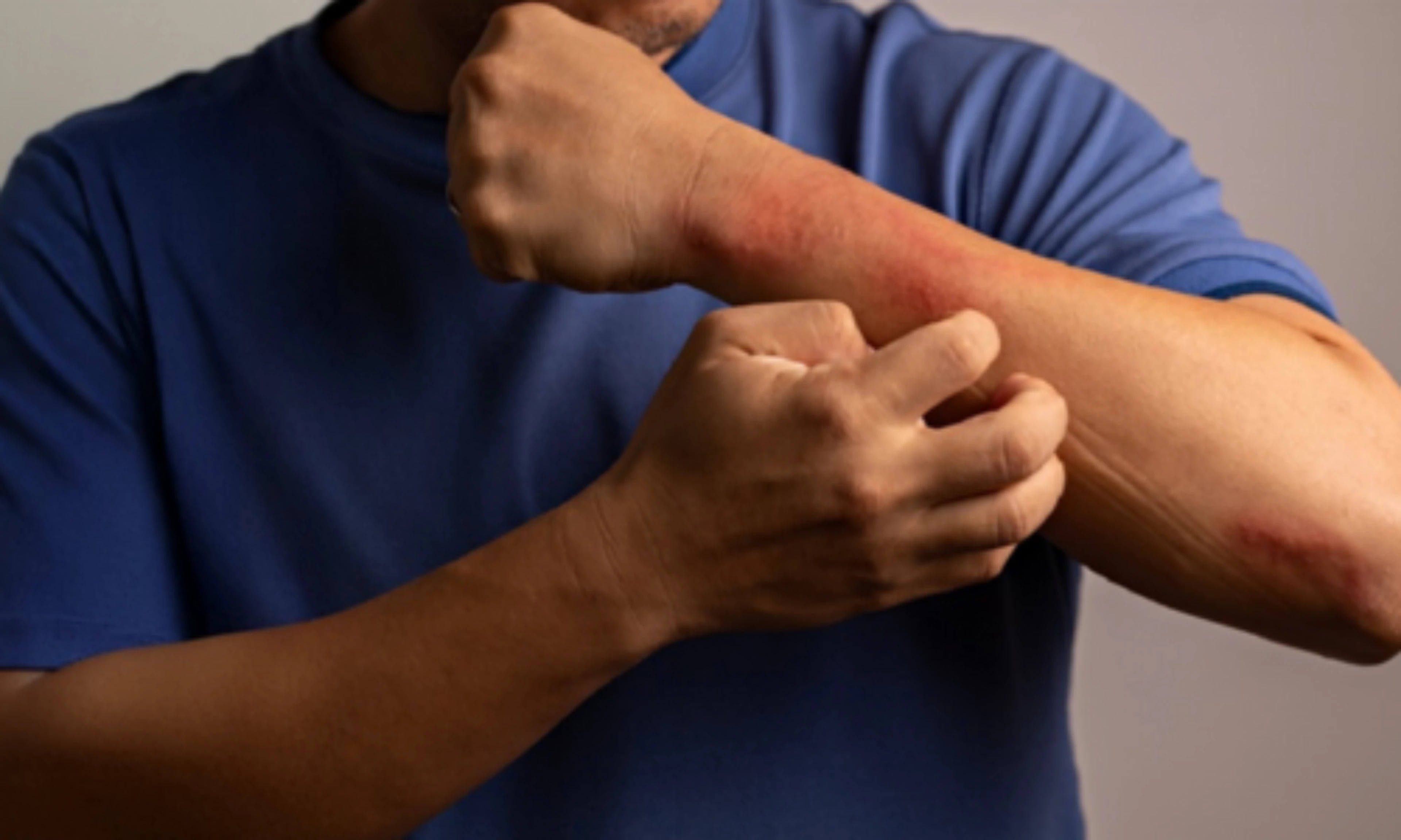 carga-acumulada-enfermedad-dermatitis-atopica-th