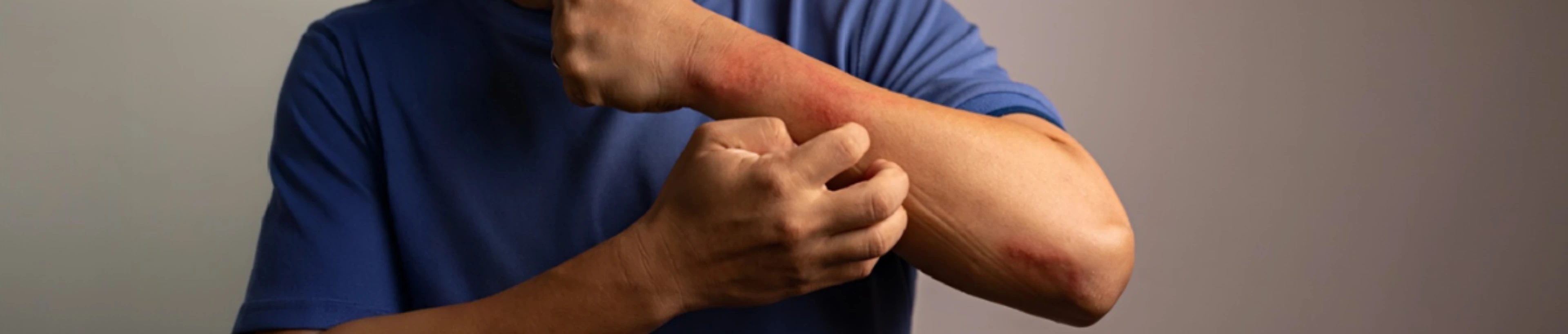 carga-acumulada-enfermedad-dermatitis-atopica-bb