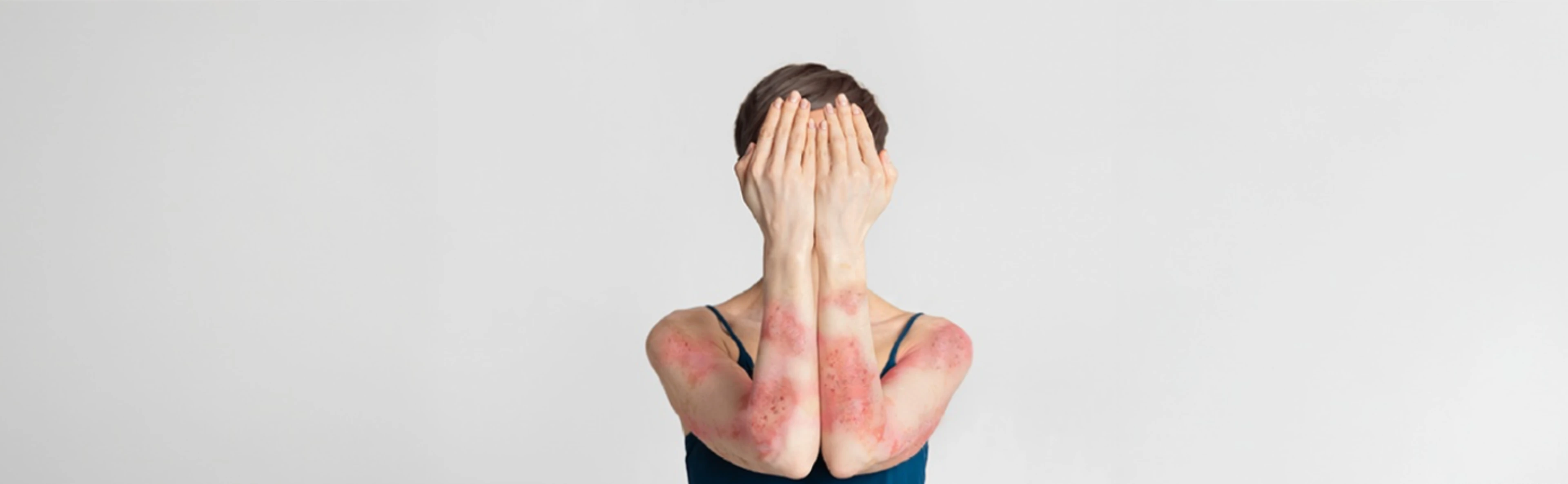El Impacto Oculto de la Carga Acumulada de la Enfermedad (CLCI) en Dermatología