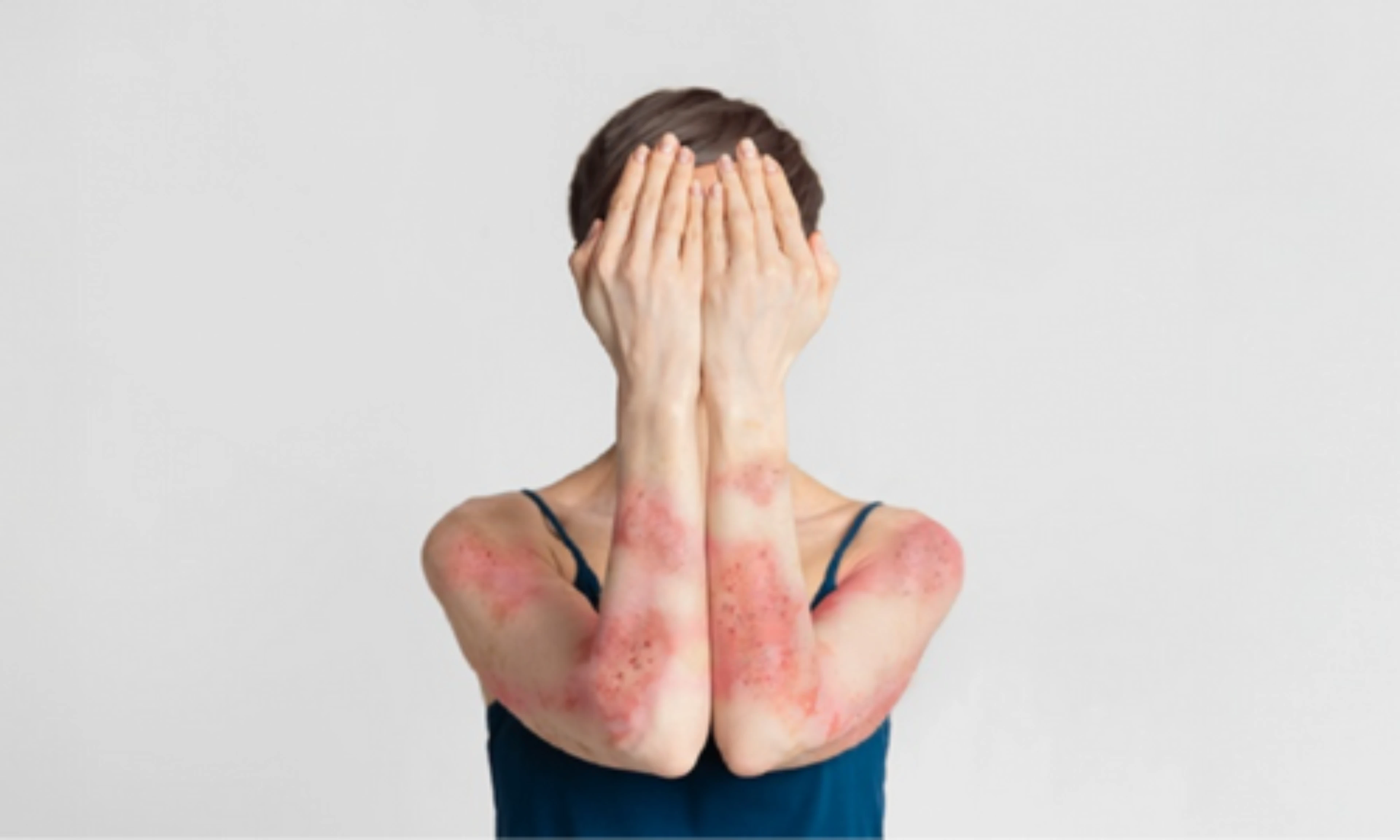 impacto-carga-acumulada-enfermedad-dermatologia-th