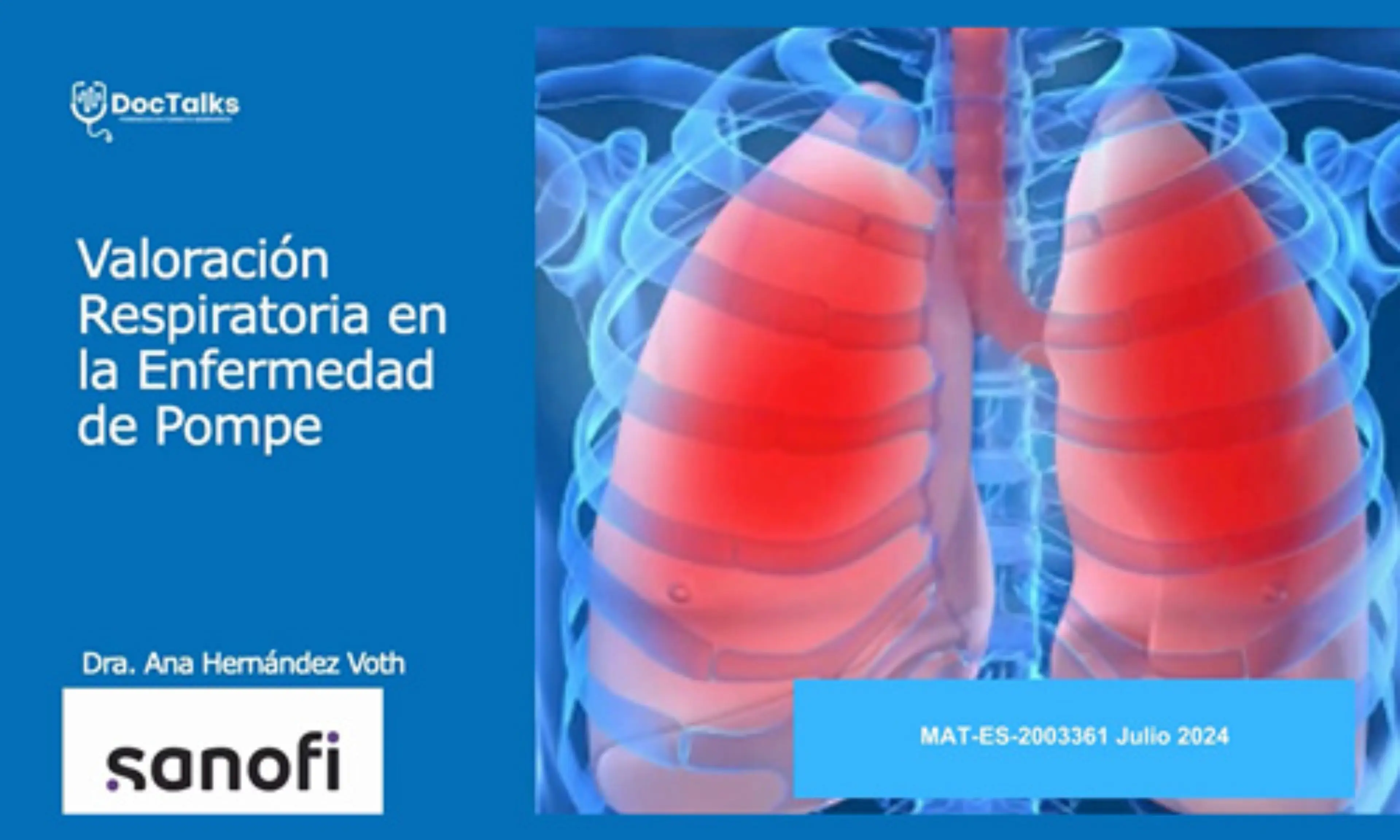 Valoración respiratoria en la Enfermedad de Pompe - Webinar Ana Hernández