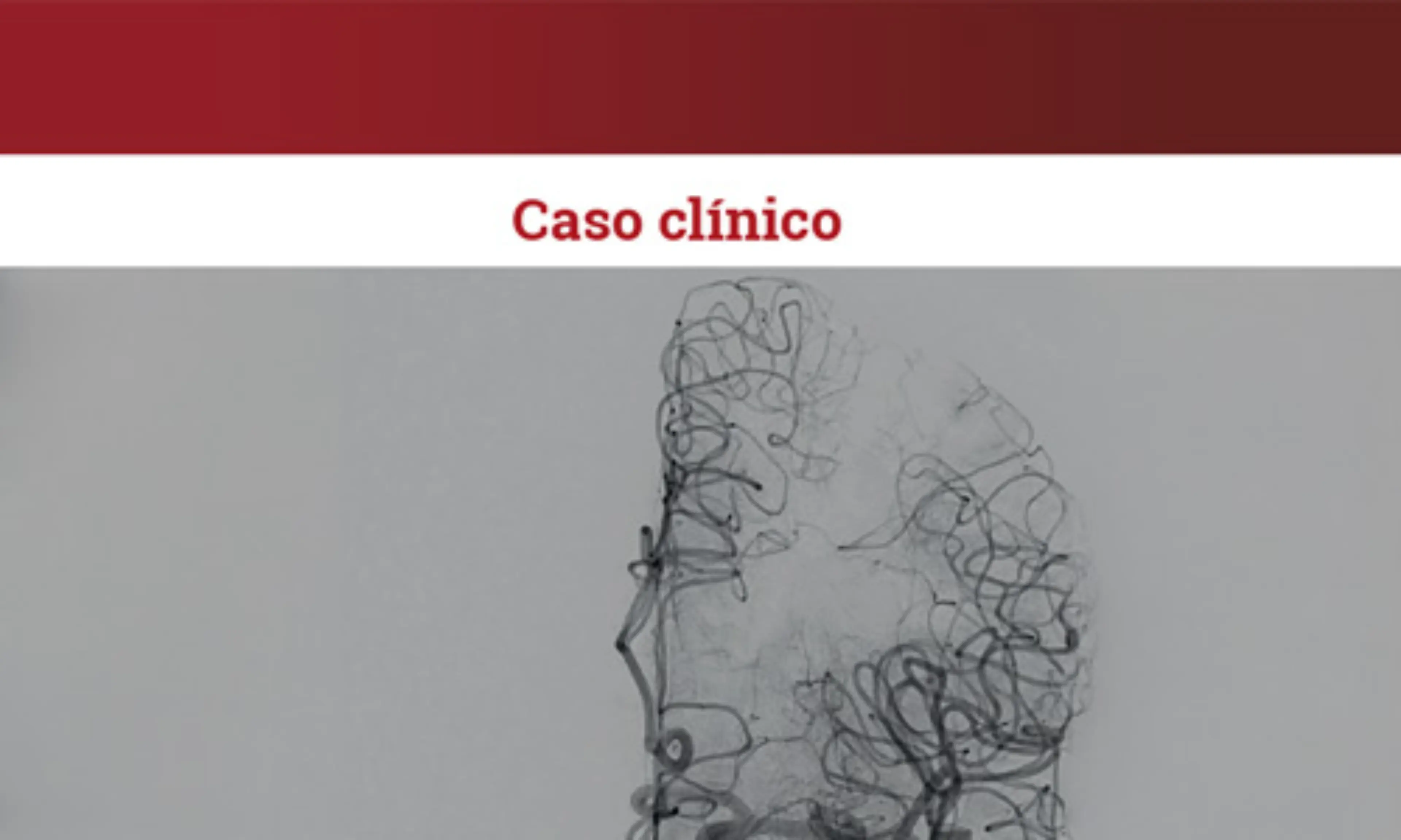 Caso clínico | Manejo de la PTTa: importancia del diagnóstico precoz