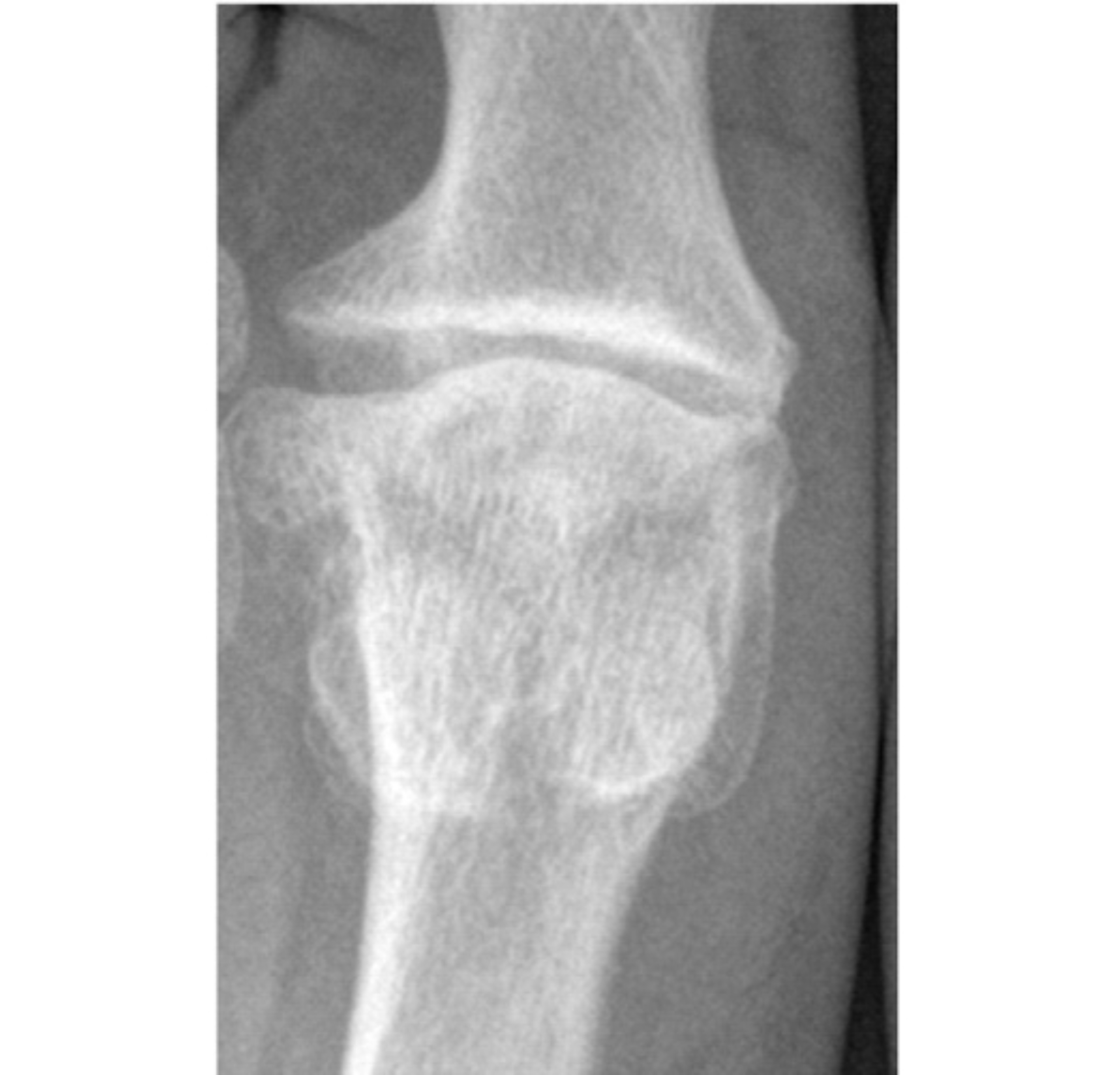 artrosis-de-la-articulacion-metatarsofalangica-caso-clinico