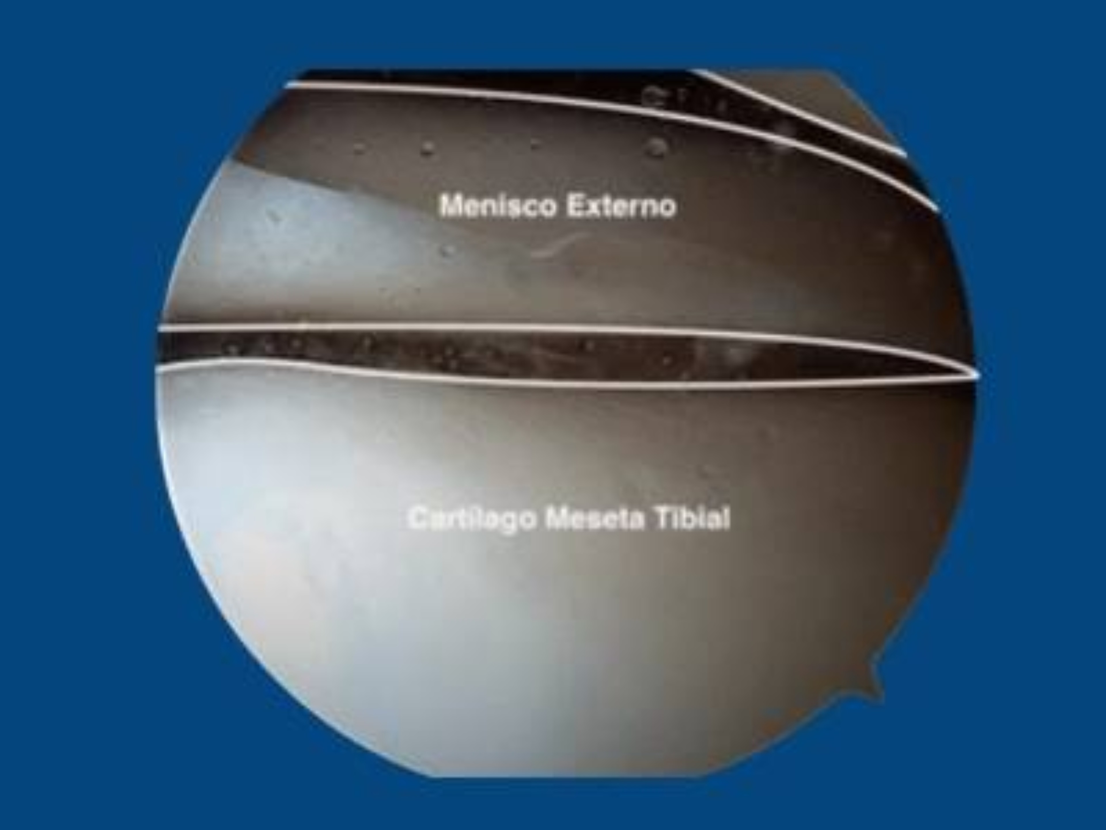 viscosuplementacion-rodilla-artroscopica