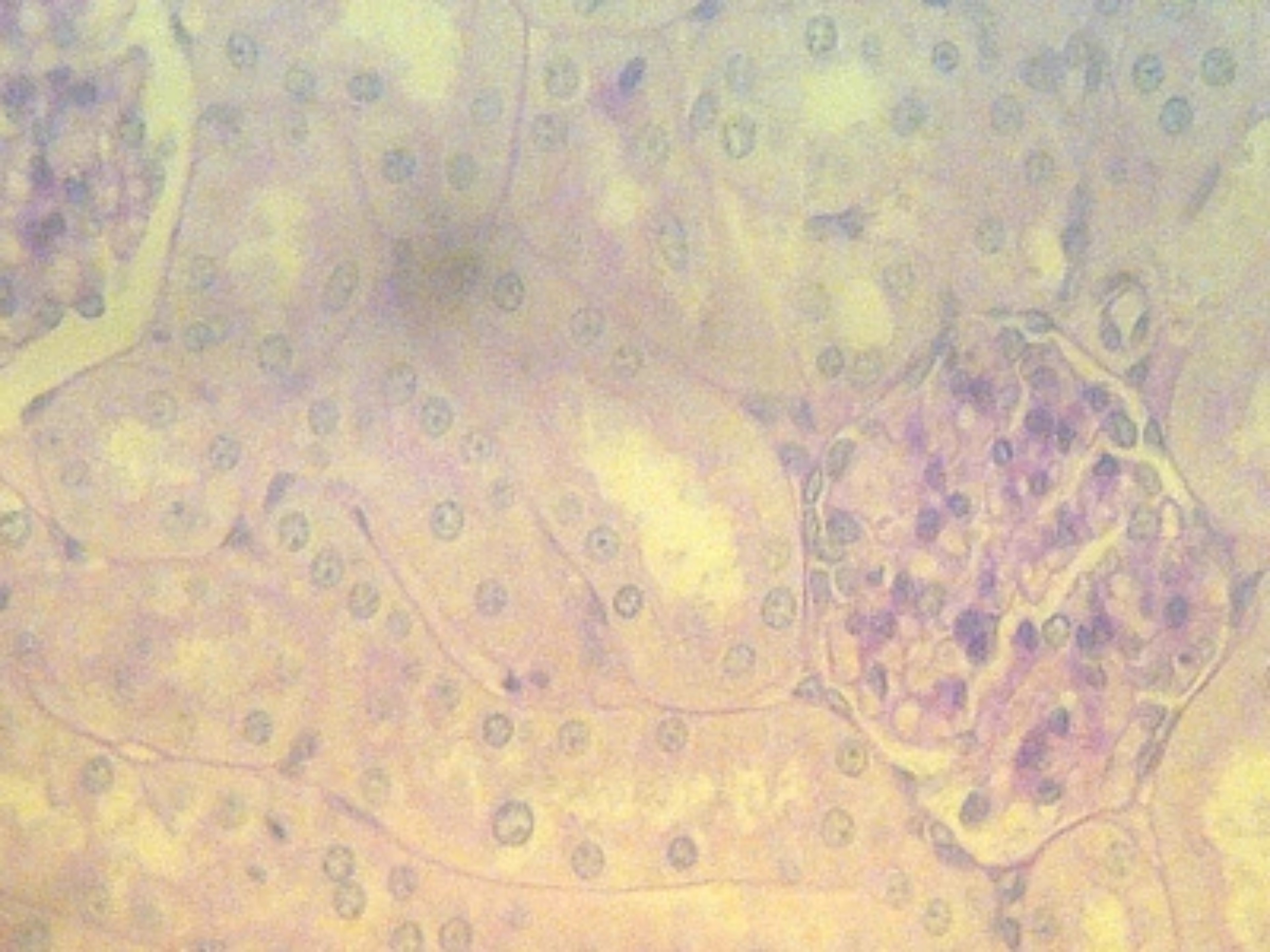 induccion-globulina-antitimocitica