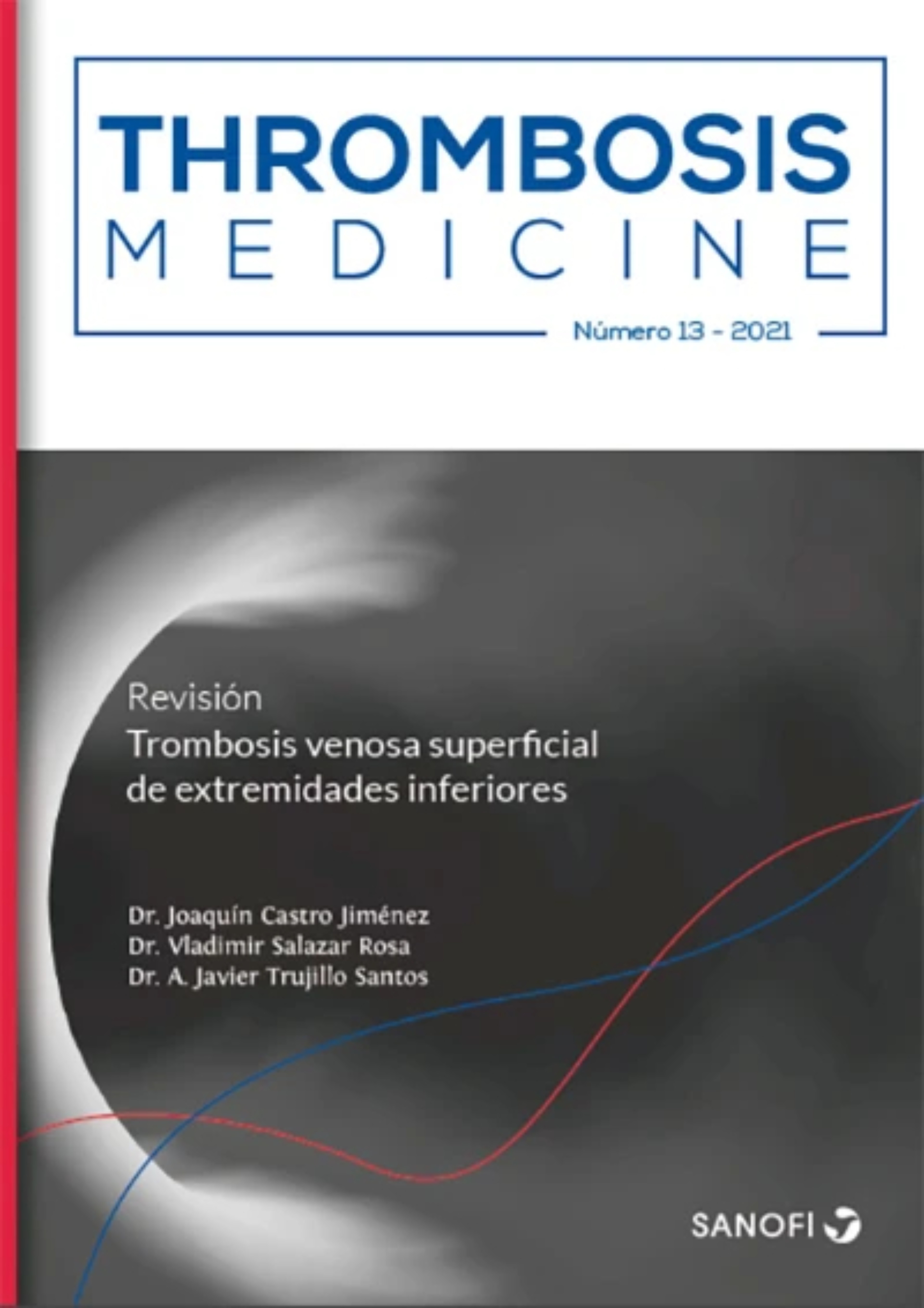 trombosis-venosa-superficial-extremidades-inferiores