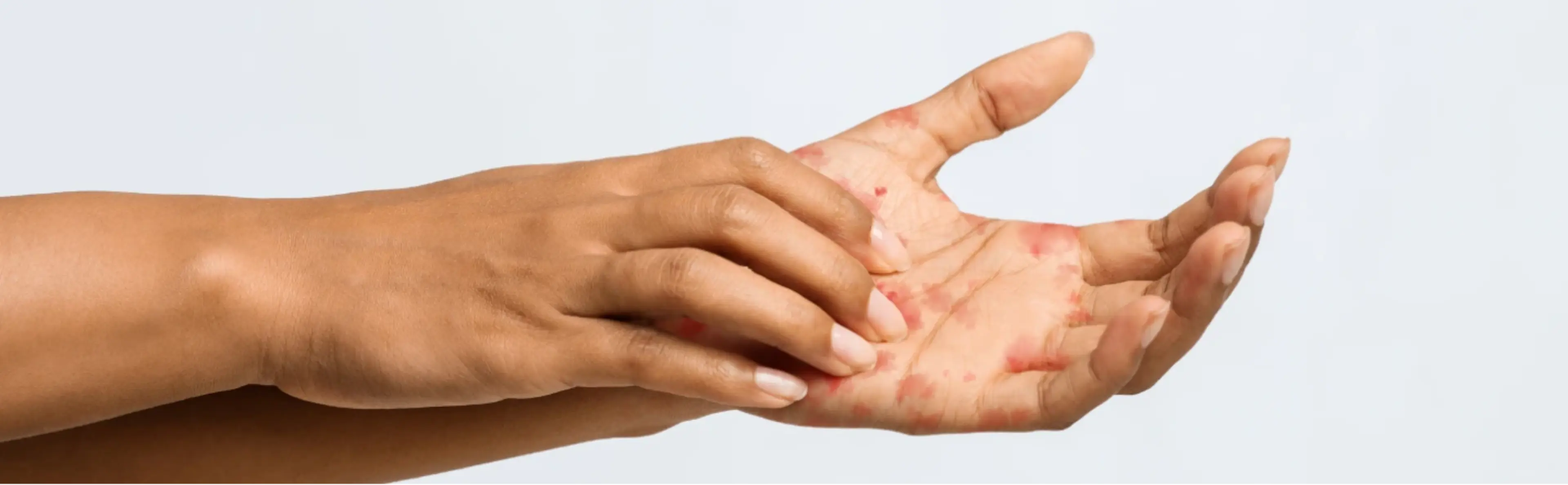 Eczema de contacto irritativo