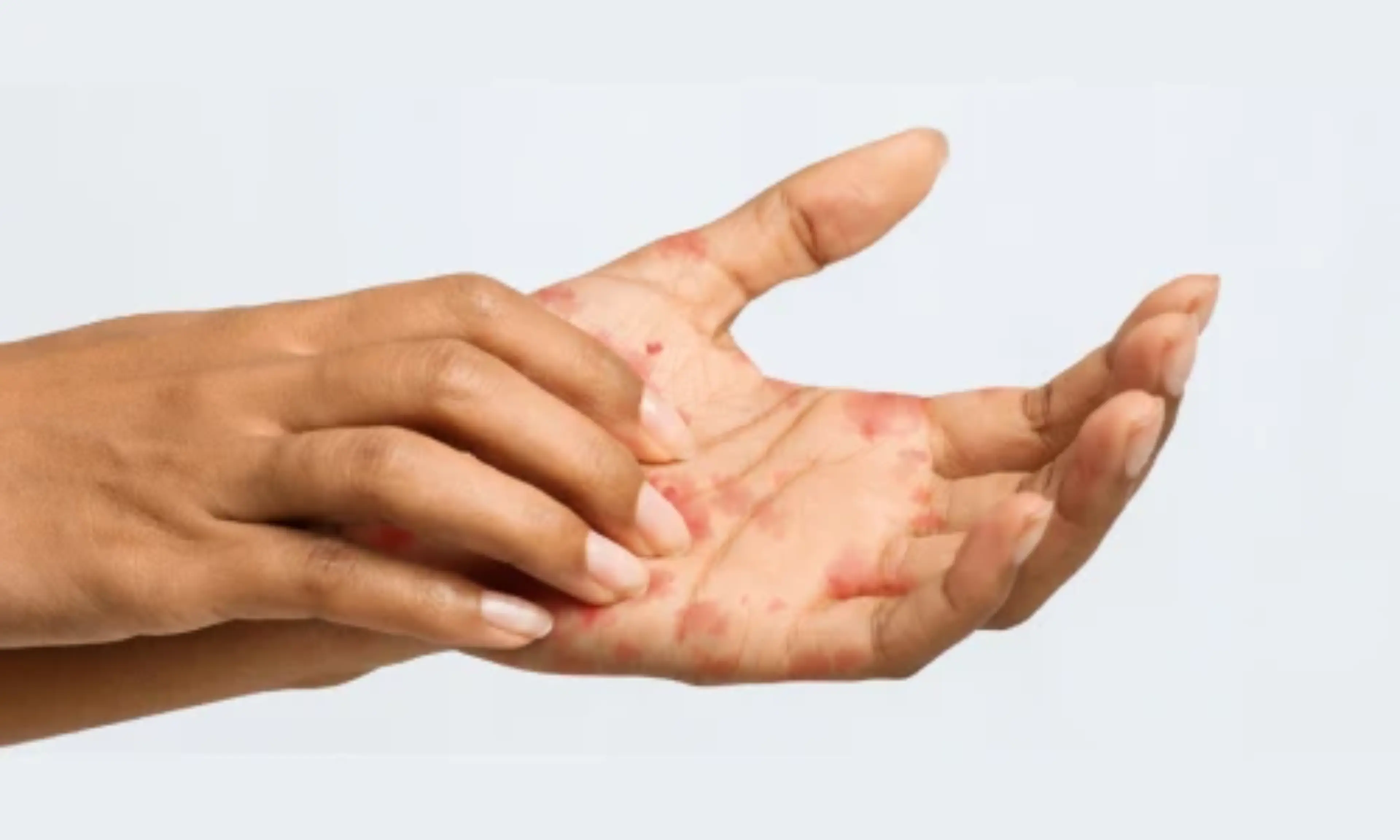 Eczema de contacto irritativo