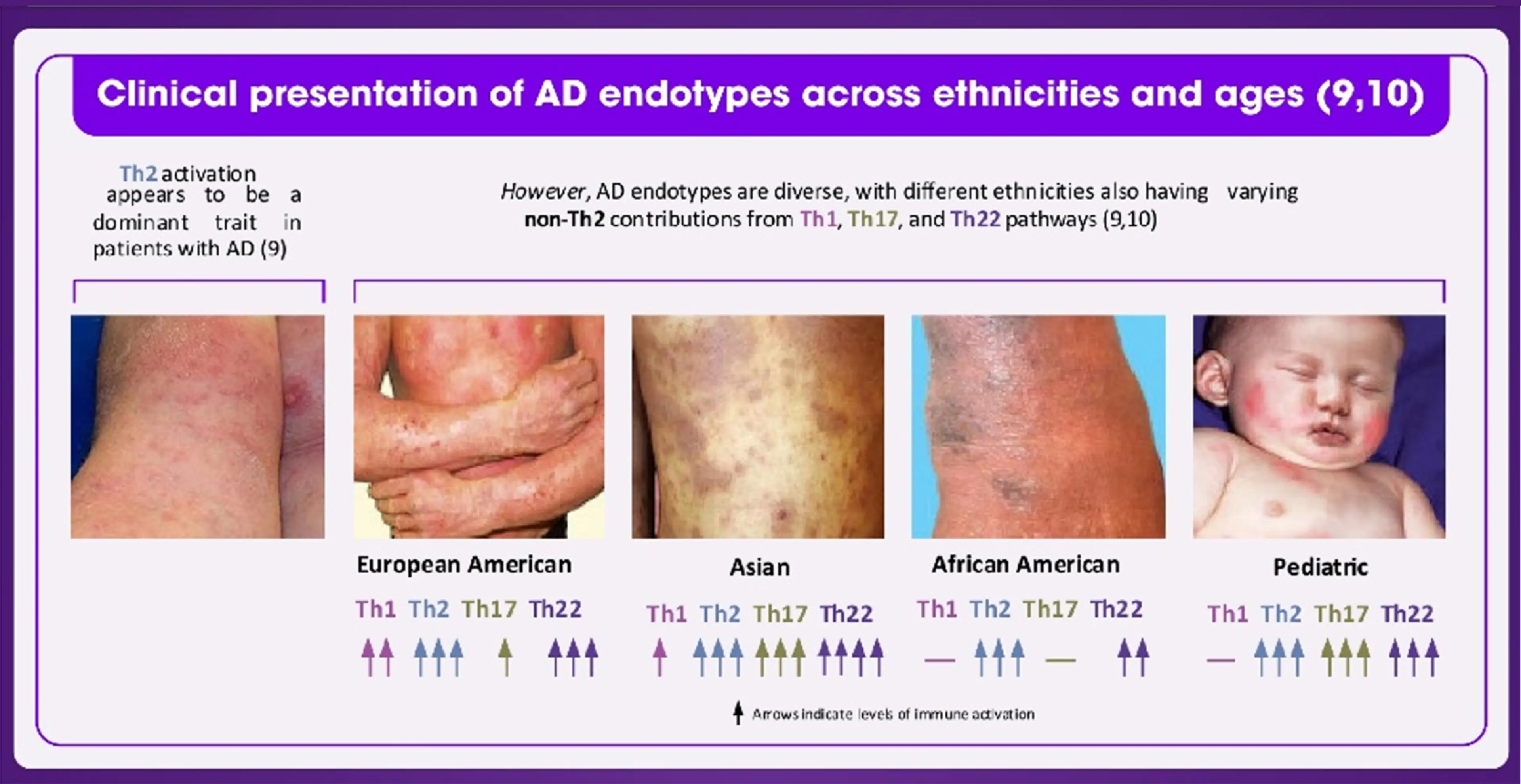 Atopic Dermatitis: Immune Endotypes and the OX40-OX40L Pathway