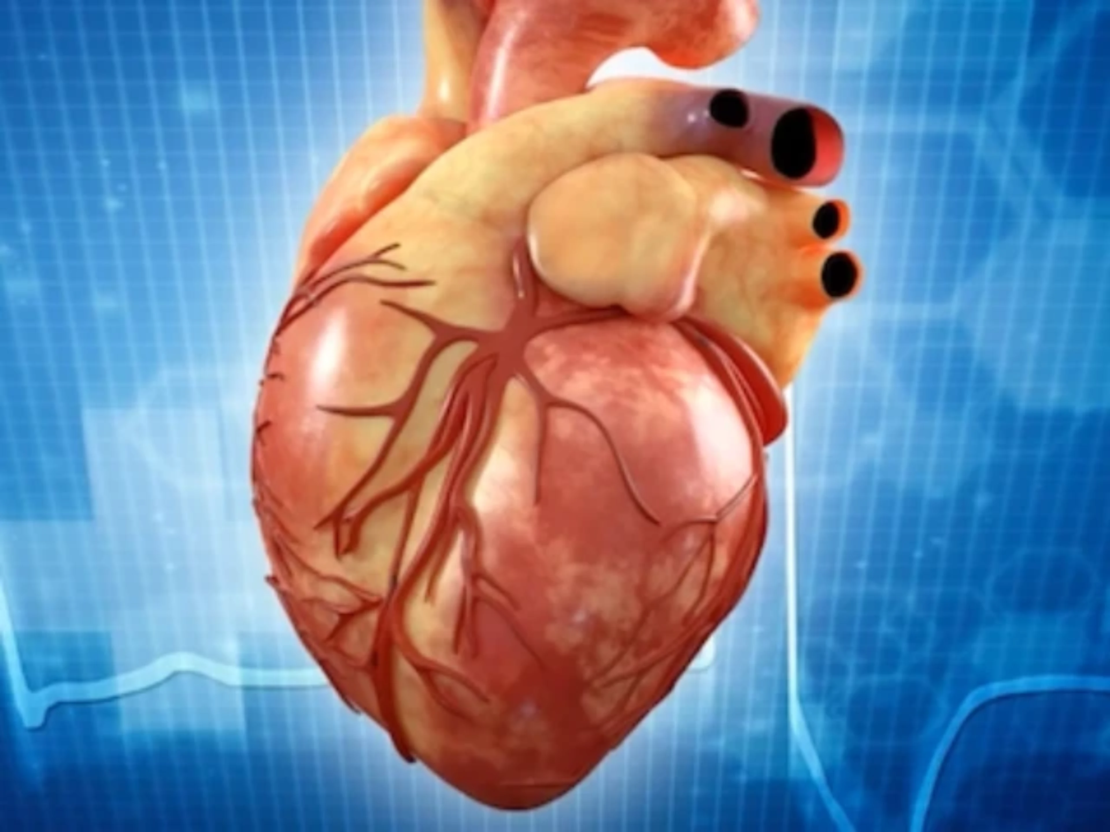 Metabolic Risk Factors and Effect of Alirocumab on CV Events