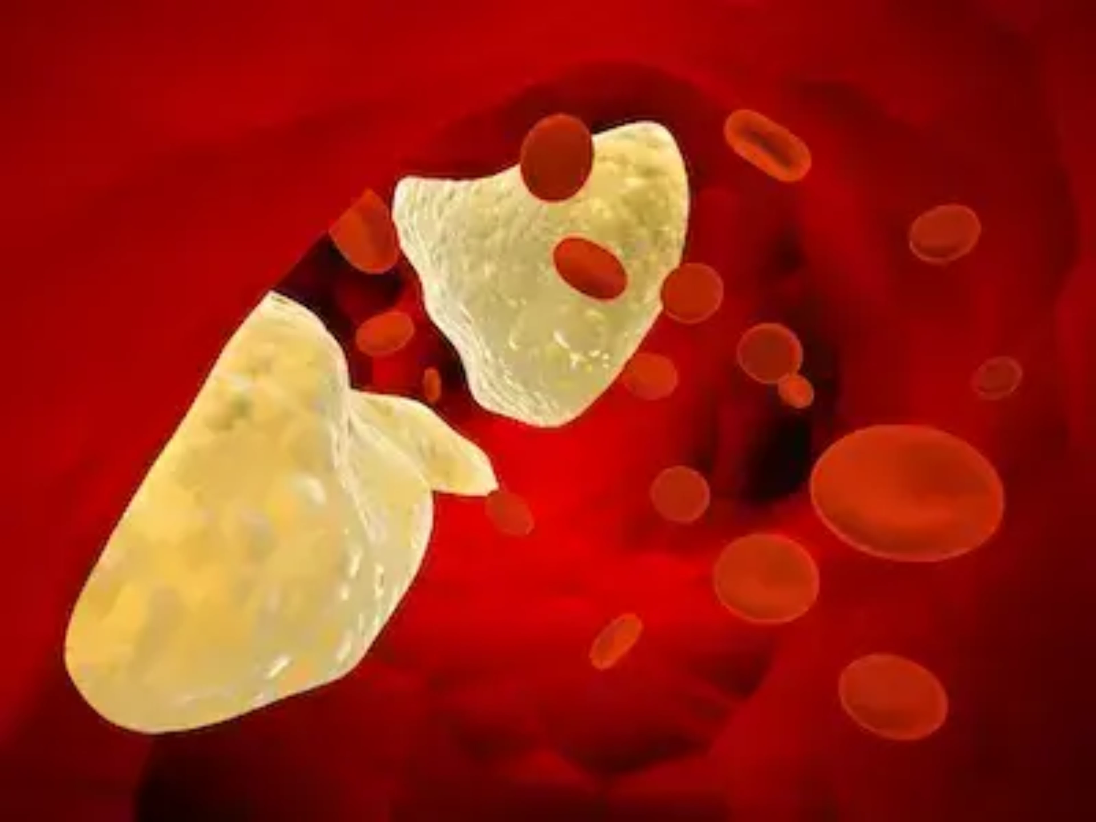 Perceptions and Barriers on the use of PCSK9 inhibitors