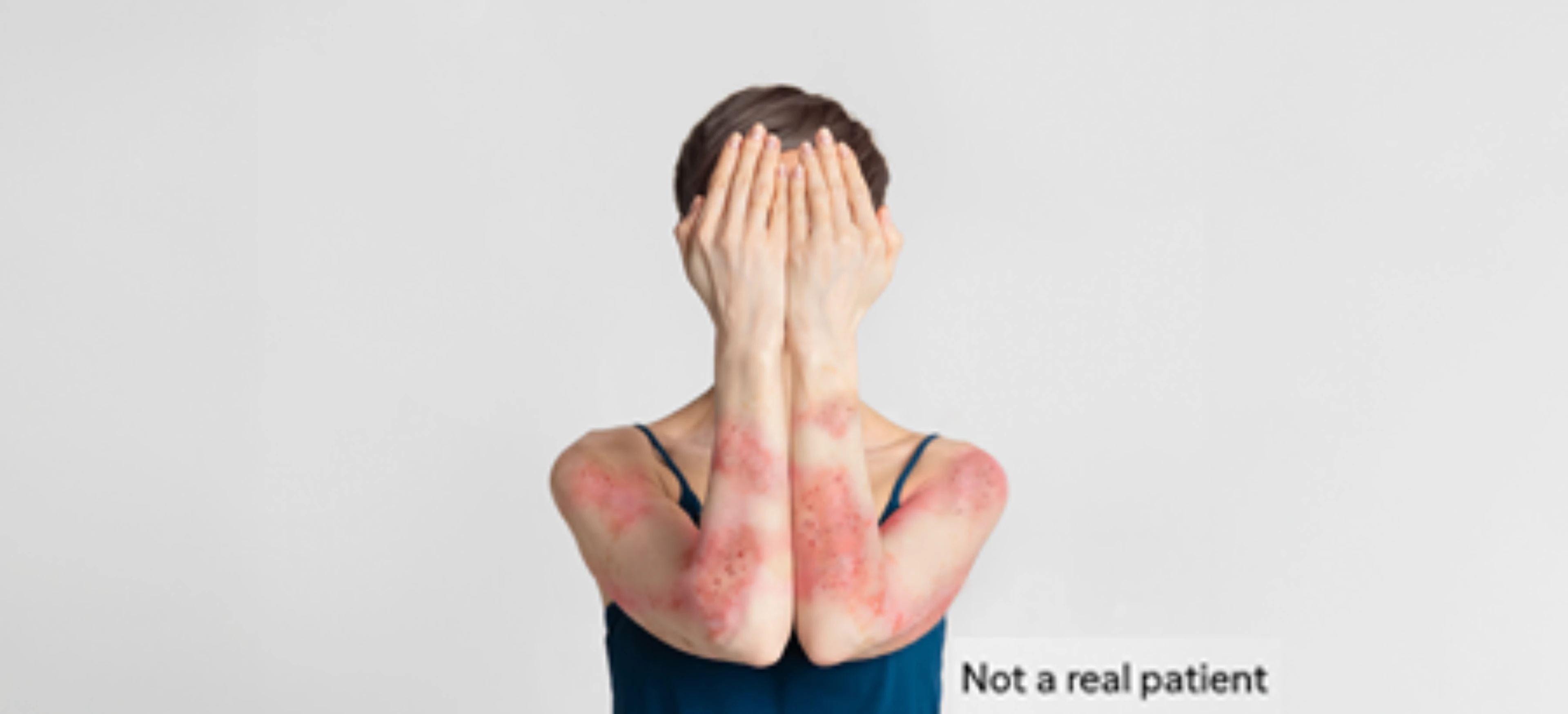 Women with dermatitis banner mobile
