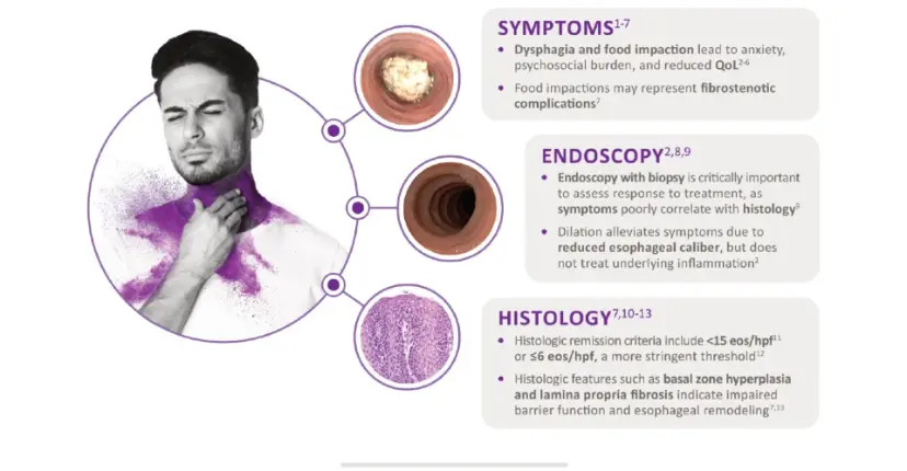 Key Disease Domains in EoE Assessment | Sanofi UAE