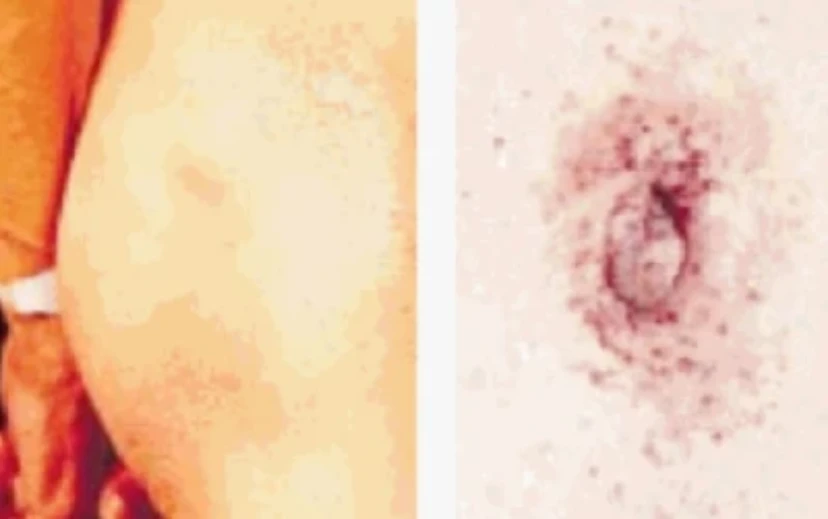 Dark red to blue-black angiokeratomas on the thigh and umbilicus regions
