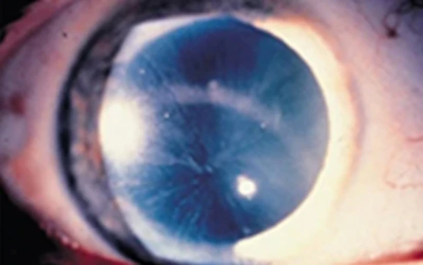 An eye with corneal whorling