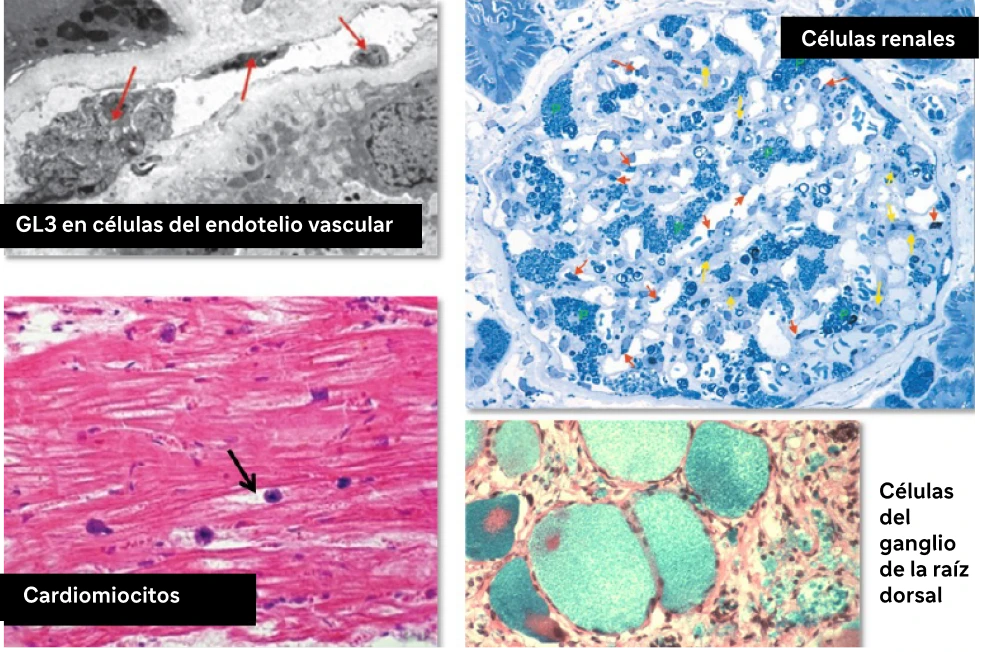 Depósito de GL3 en la enfermedad de Fabry: microscopía de células del endotelio vascular, células renales, cardiomiocitos y células del ganglio de la raíz dorsal