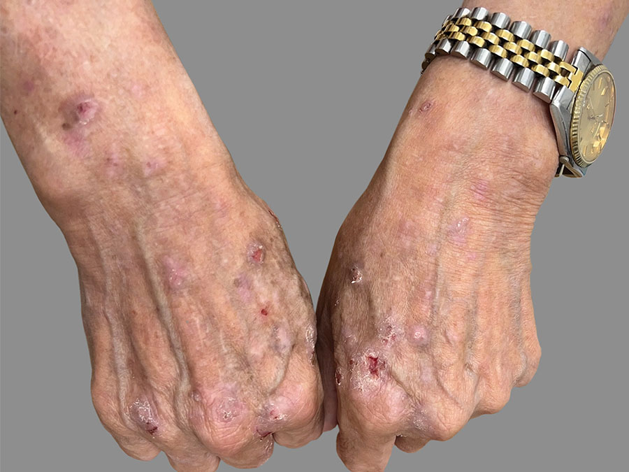 hands-nodules