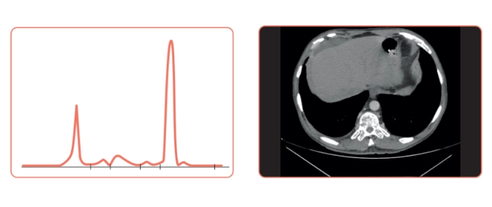 tratamiento-isatuximab-carfilzomibdexametasona-paciente-refractario-lenalidomida-figura-1-2