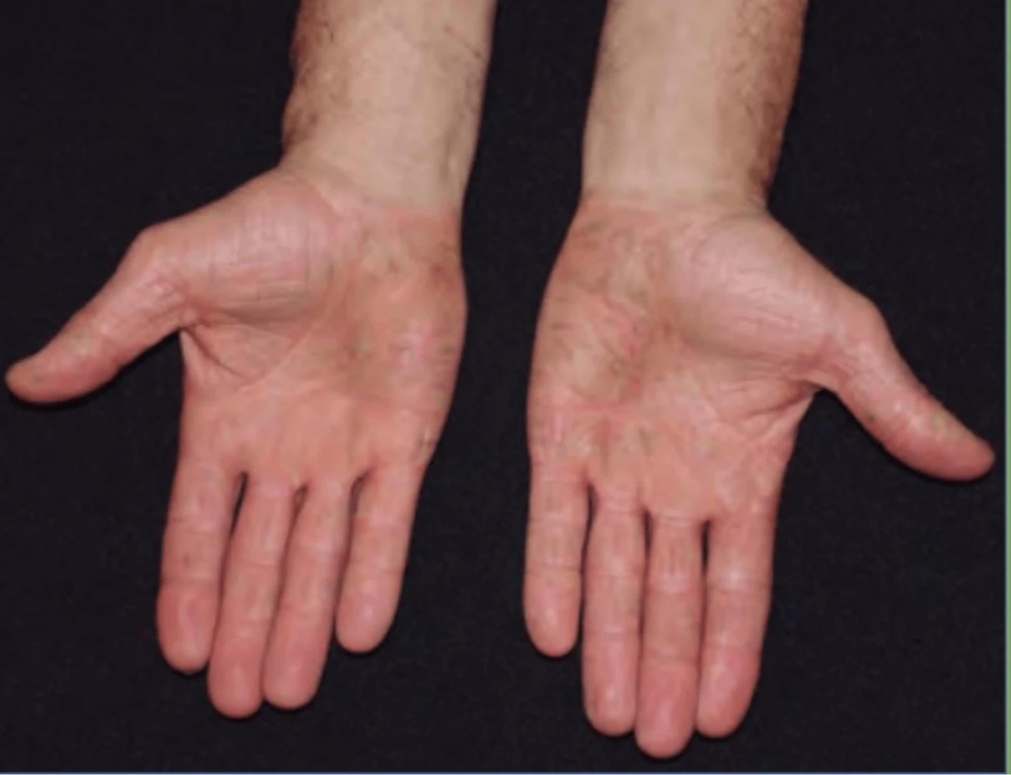 eczema contacto irritativo palmar