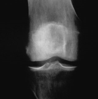 Röntgenbild eines Gelnks mit Erlenmeyerkolben-Deformität als typisches Symptom der Morbus Gaucher Krankheit