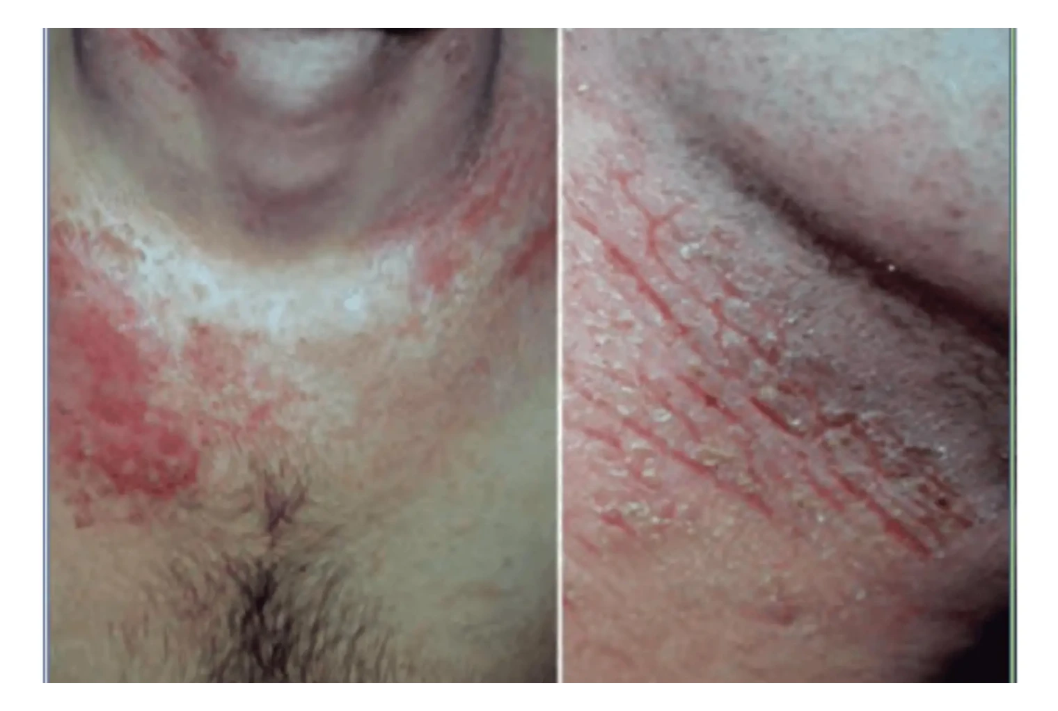 imagen dermatitis atopica adulto
